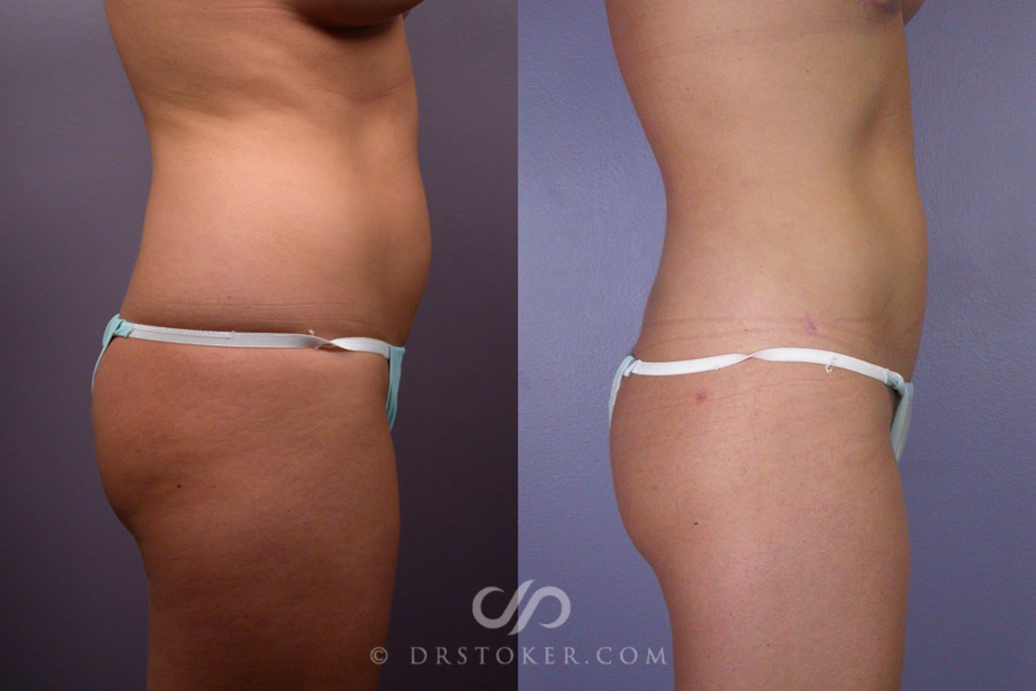 Before & After Liposuction Case 173 View #4 View in Los Angeles, CA