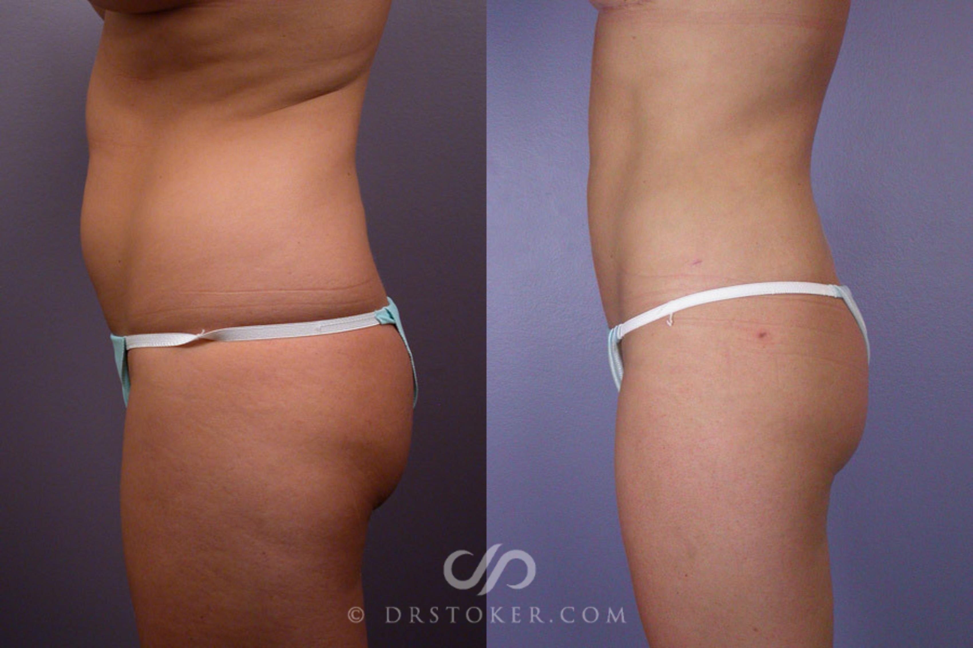 Before & After Liposuction Case 173 View #5 View in Los Angeles, CA