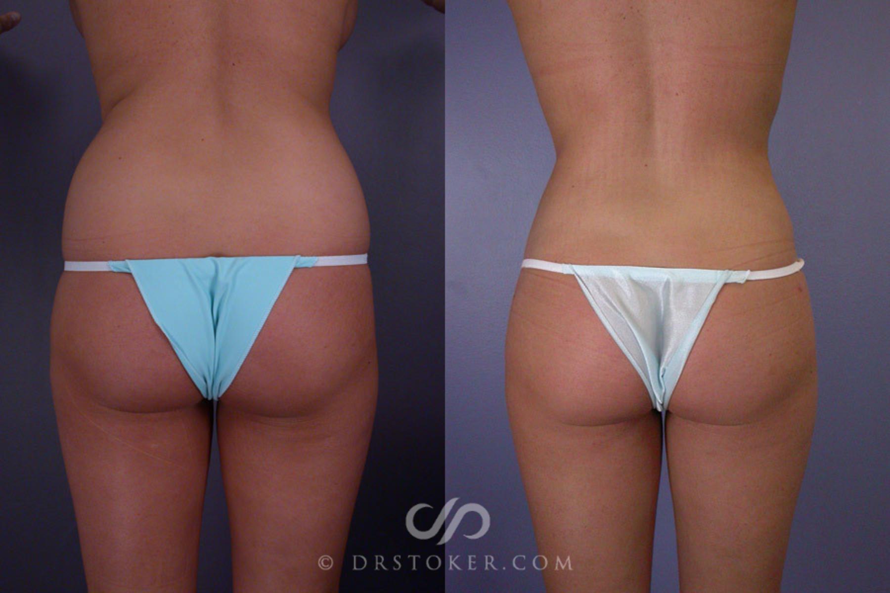 Before & After Liposuction Case 173 View #6 View in Los Angeles, CA