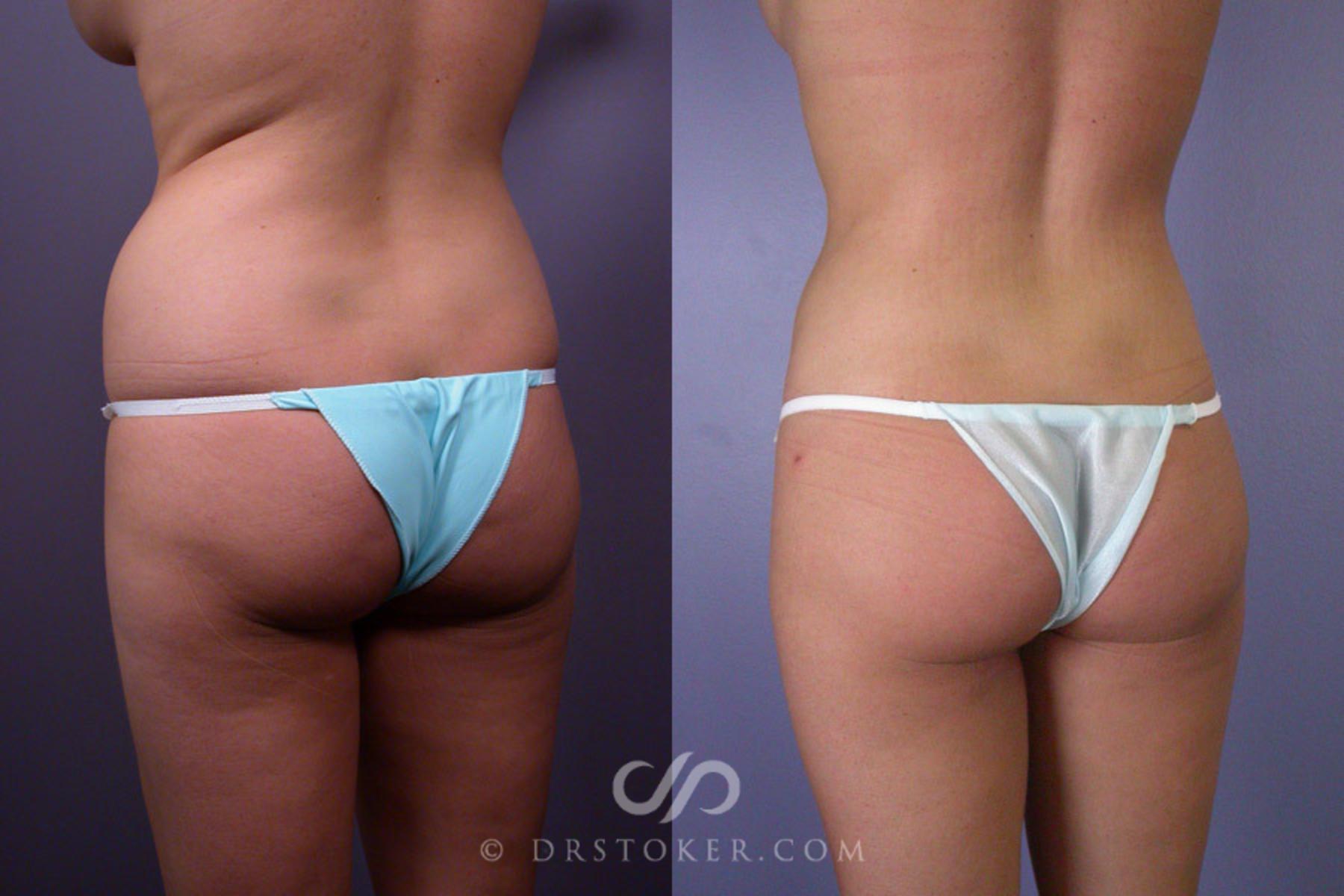 Before & After Liposuction Case 173 View #7 View in Los Angeles, CA