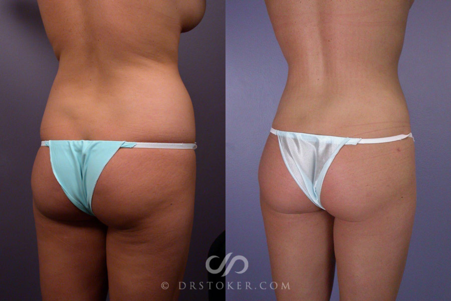 Before & After Liposuction Case 173 View #8 View in Los Angeles, CA