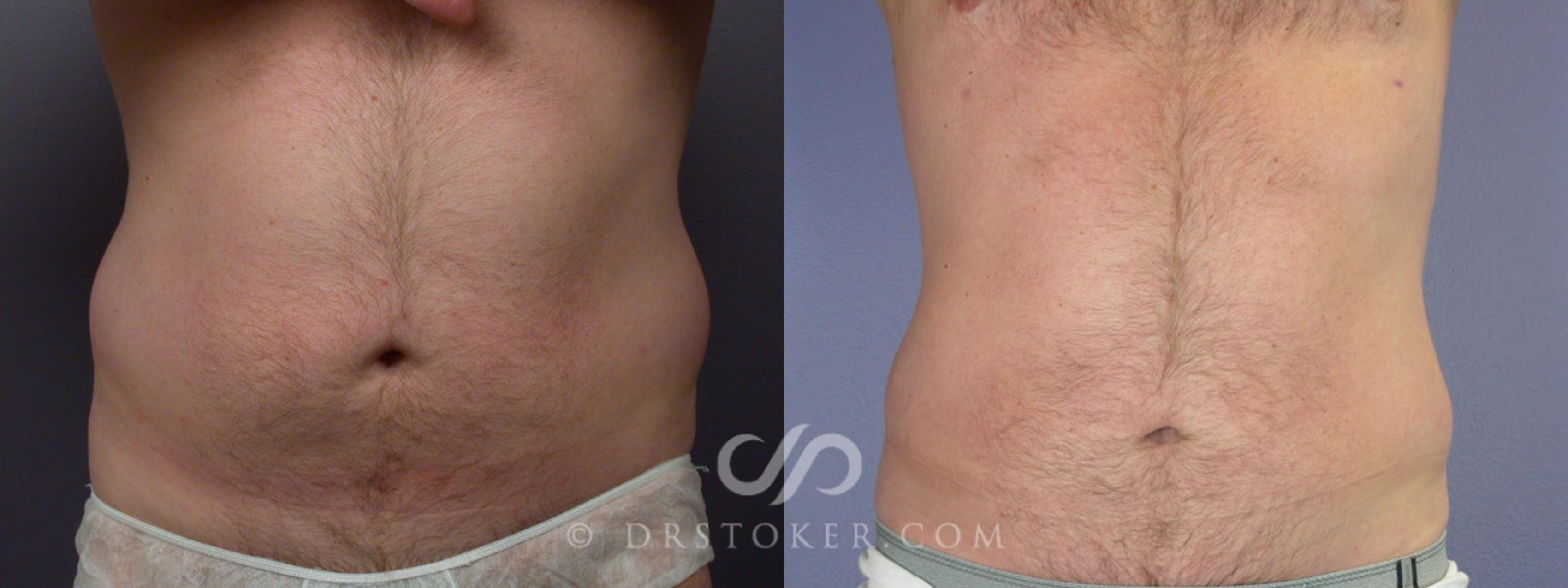 Before & After Liposuction for Men Case 174 View #1 View in Los Angeles, CA