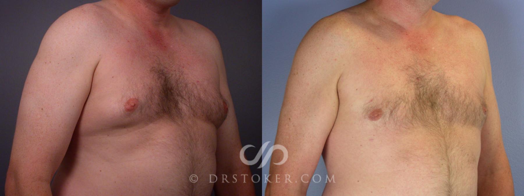 Before & After Liposuction Case 174 View #10 View in Los Angeles, CA