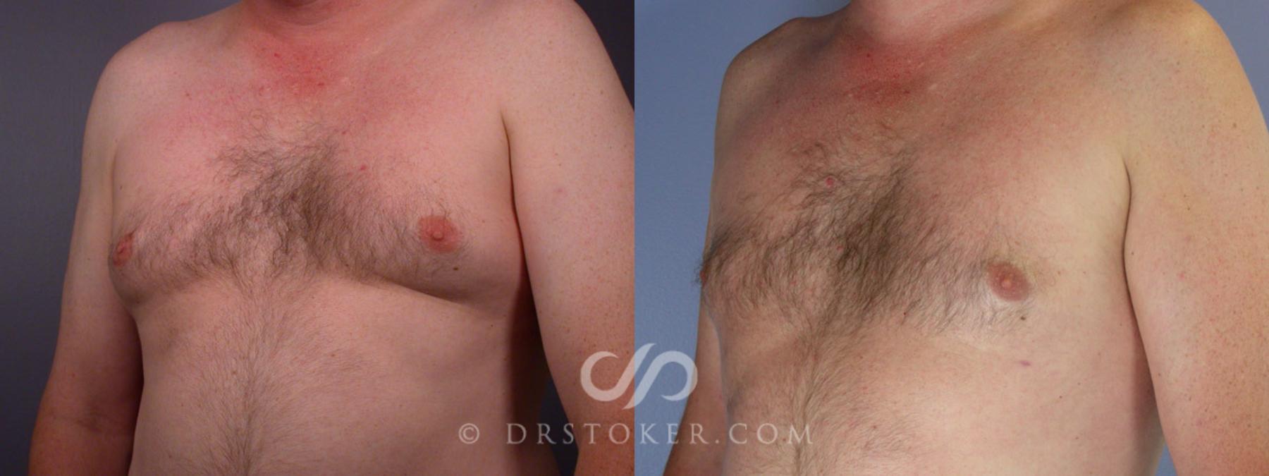 Before & After Liposuction Case 174 View #11 View in Los Angeles, CA