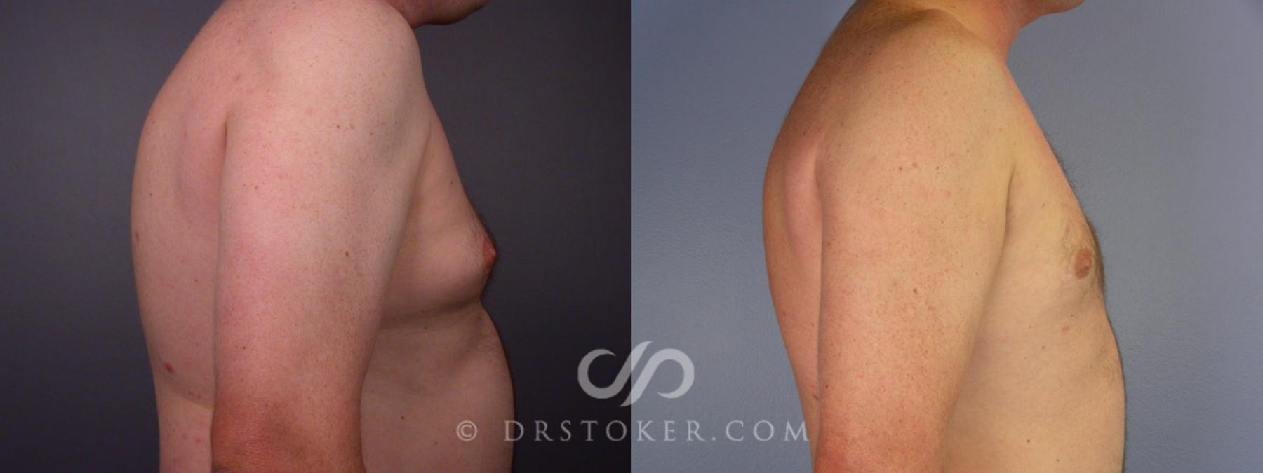 Before & After Liposuction Case 174 View #12 View in Los Angeles, CA