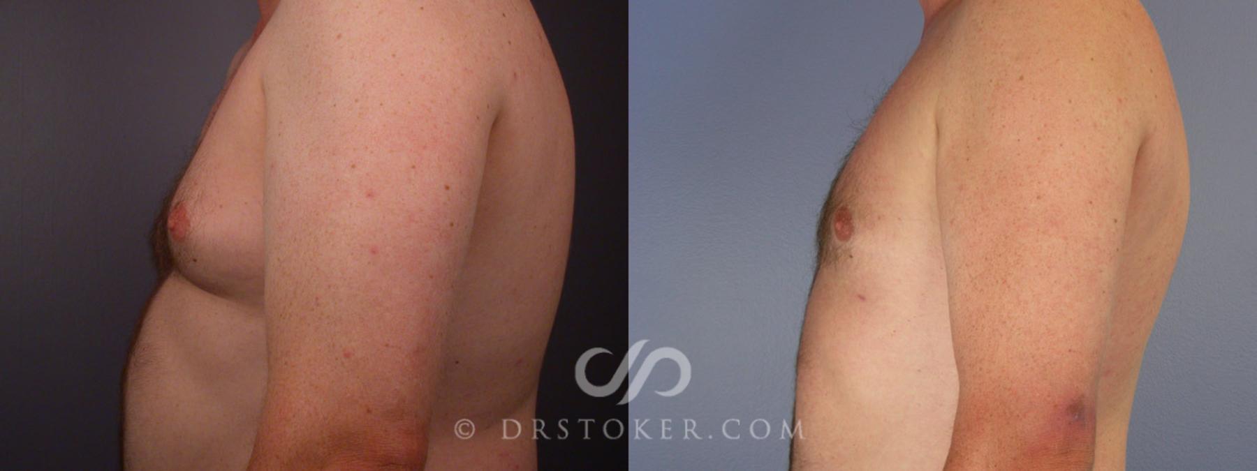 Before & After Liposuction Case 174 View #13 View in Los Angeles, CA