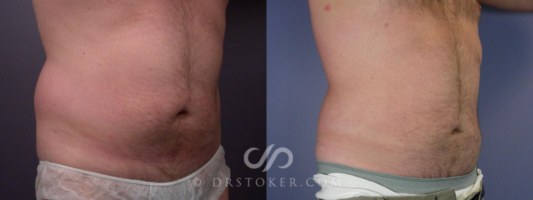 Before & After Liposuction Case 174 View #2 View in Los Angeles, CA