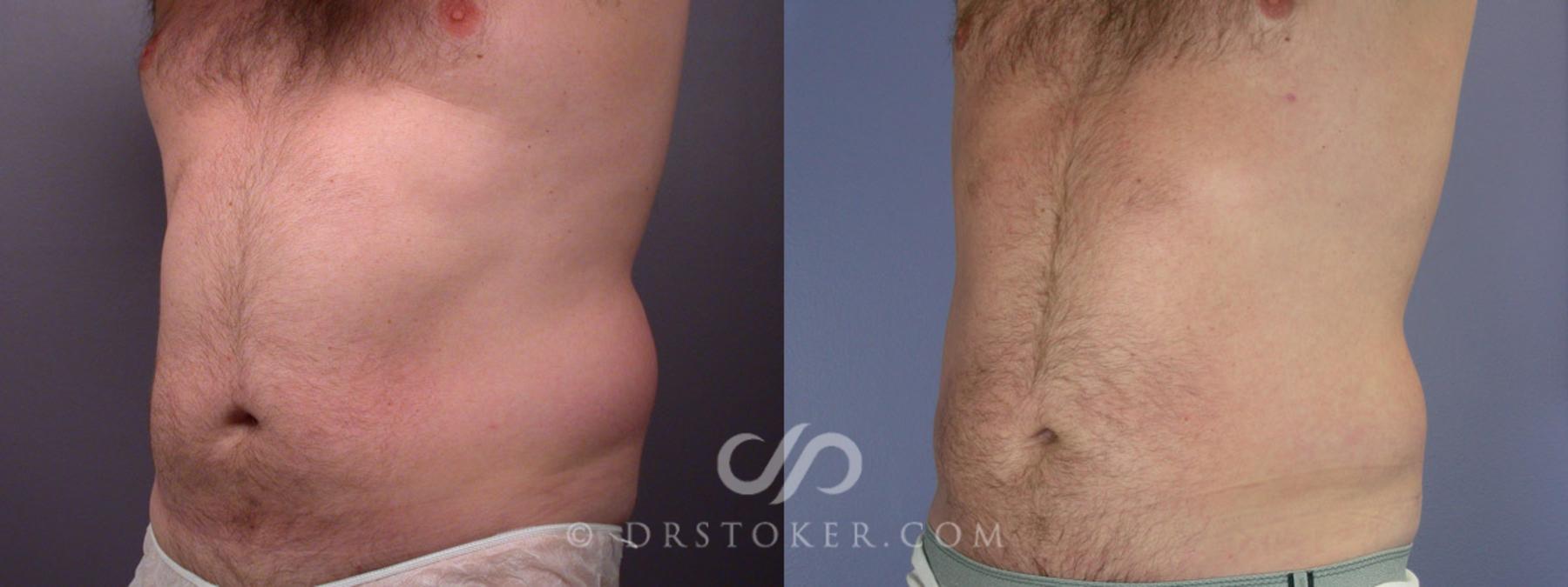 Before & After Liposuction Case 174 View #3 View in Los Angeles, CA