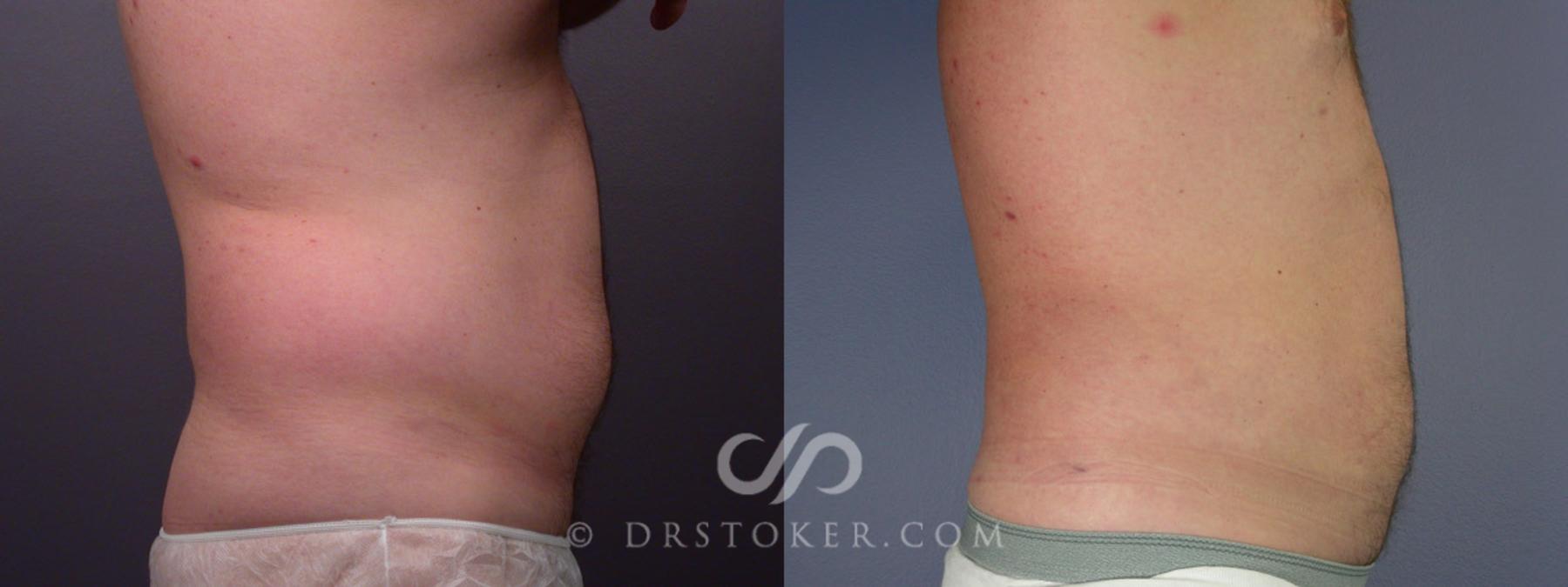 Before & After Liposuction Case 174 View #4 View in Los Angeles, CA
