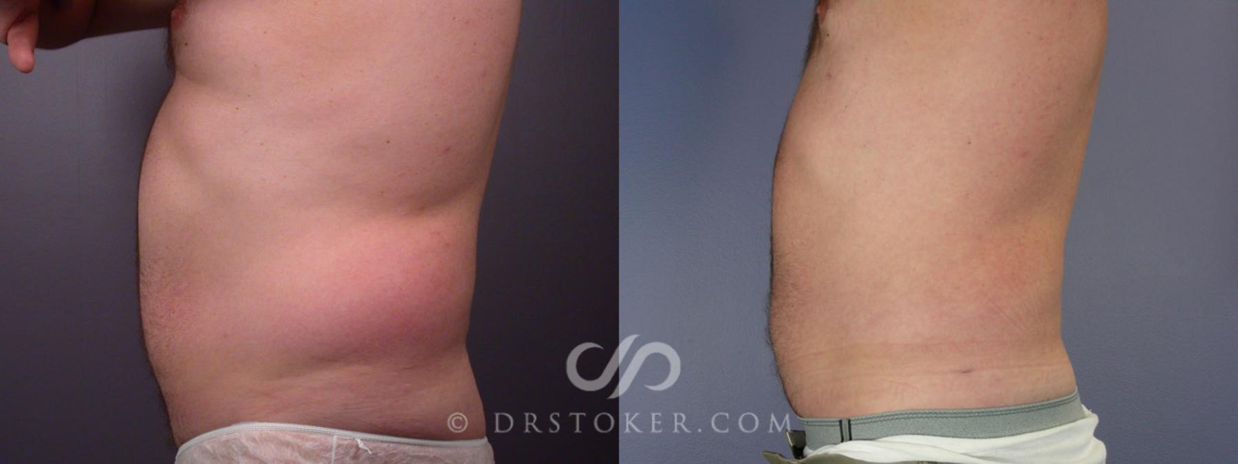 Before & After Liposuction for Men Case 174 View #5 View in Los Angeles, CA