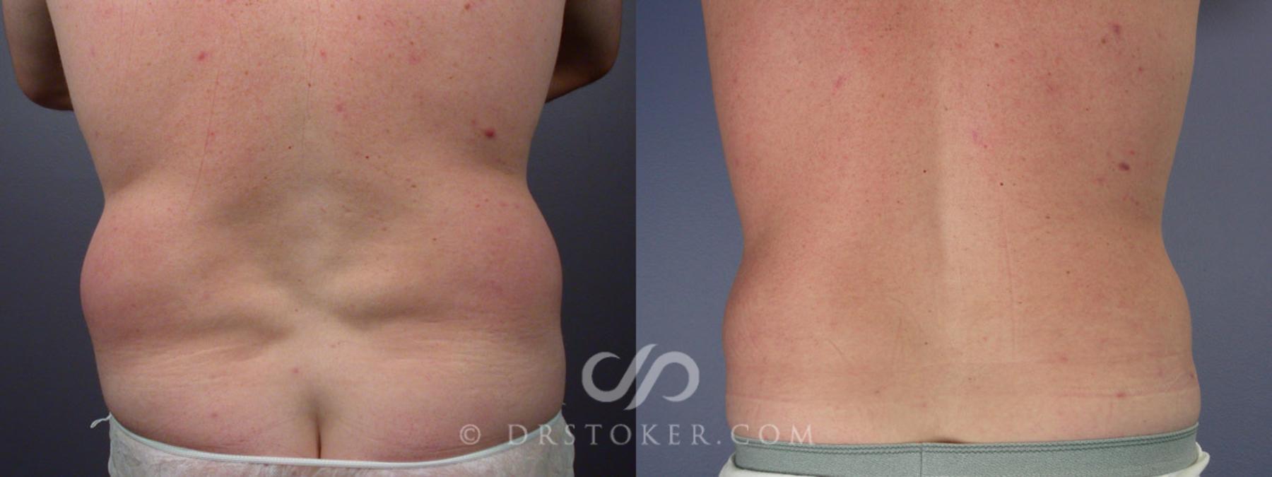 Before & After Liposuction Case 174 View #6 View in Los Angeles, CA