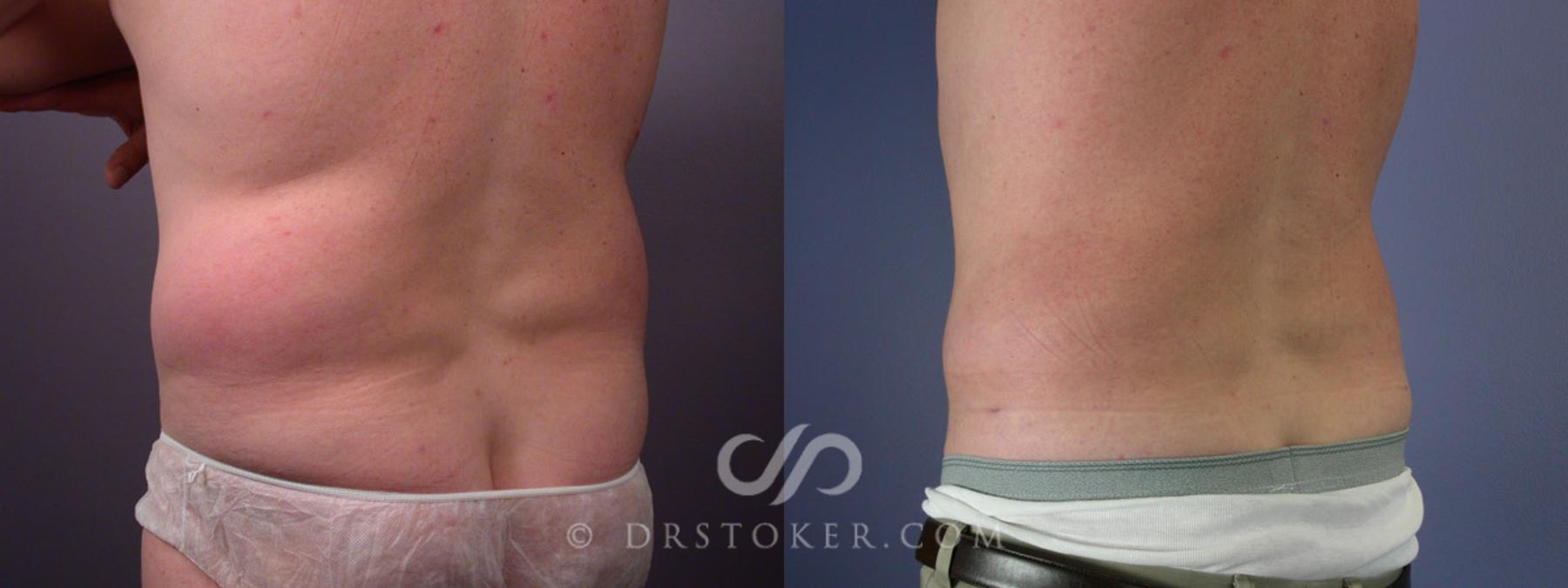 Before & After Liposuction Case 174 View #7 View in Los Angeles, CA