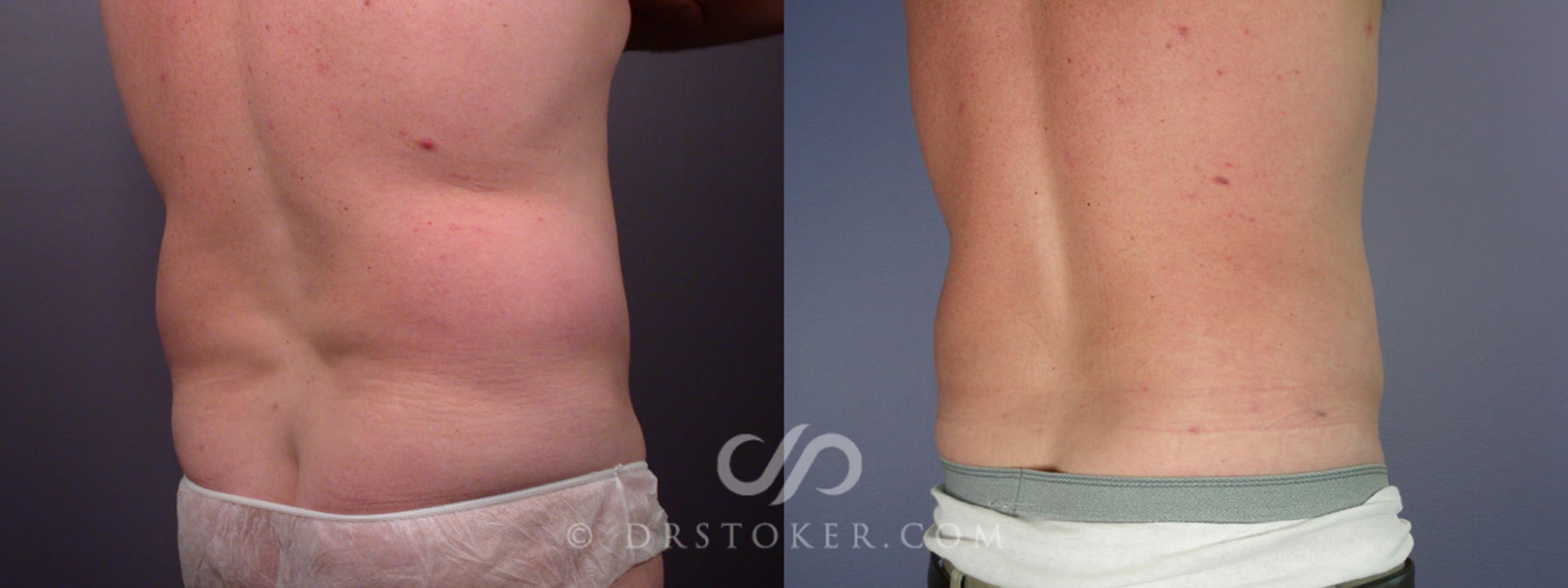 Before & After Liposuction Case 174 View #8 View in Los Angeles, CA