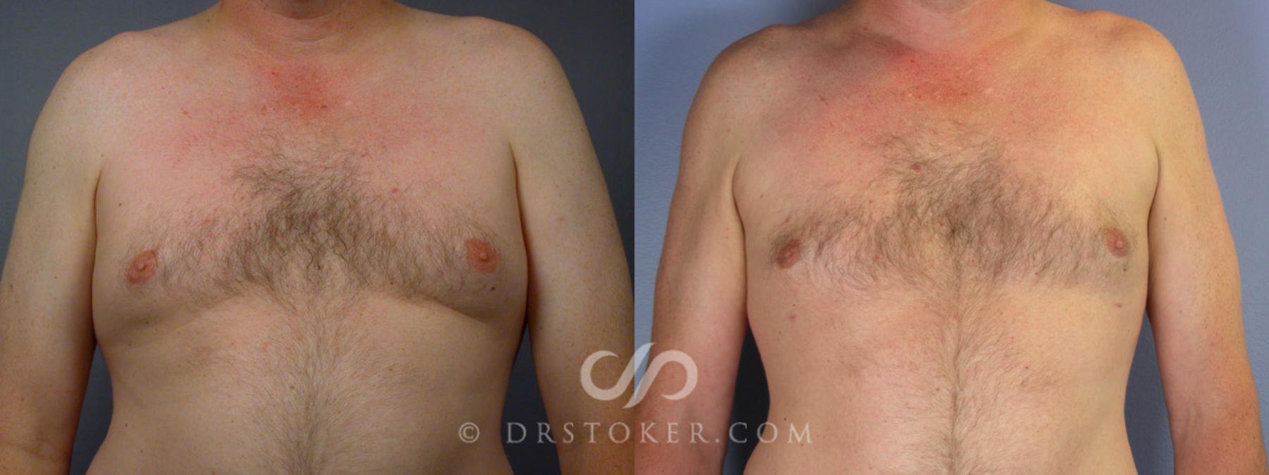 Before & After Liposuction Case 174 View #9 View in Los Angeles, CA
