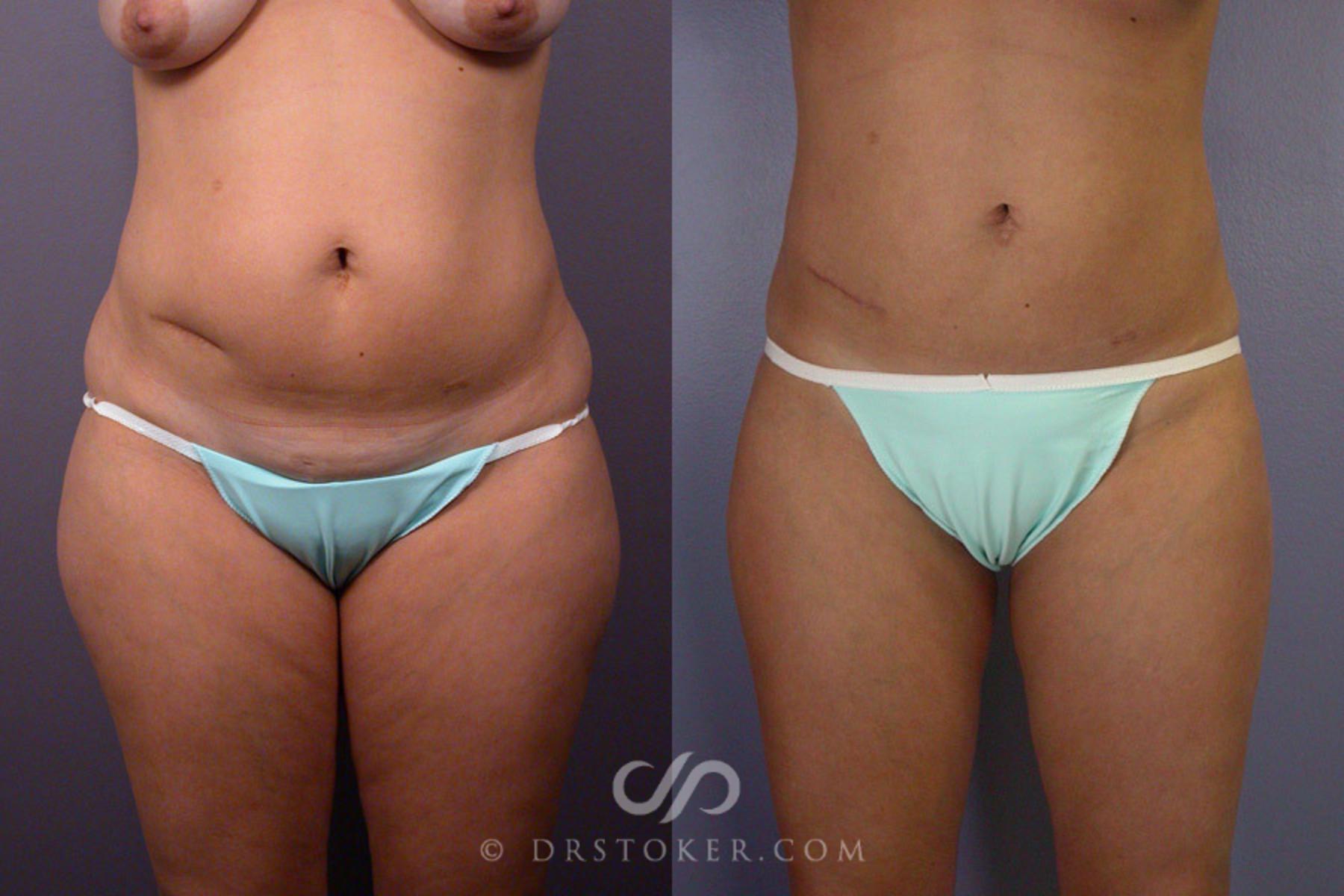 Before & After Liposuction Case 175 View #1 View in Los Angeles, CA