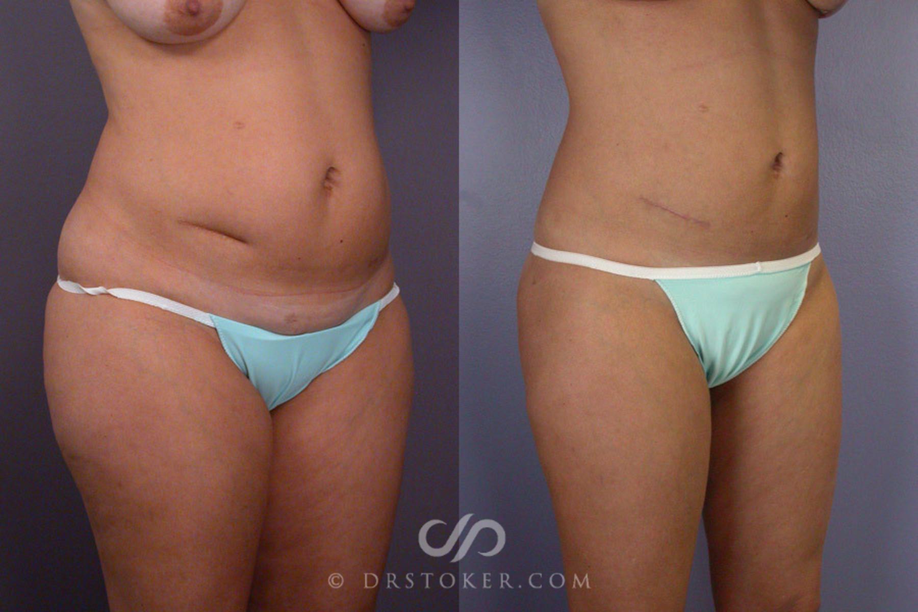 Before & After Liposuction Case 175 View #2 View in Los Angeles, CA