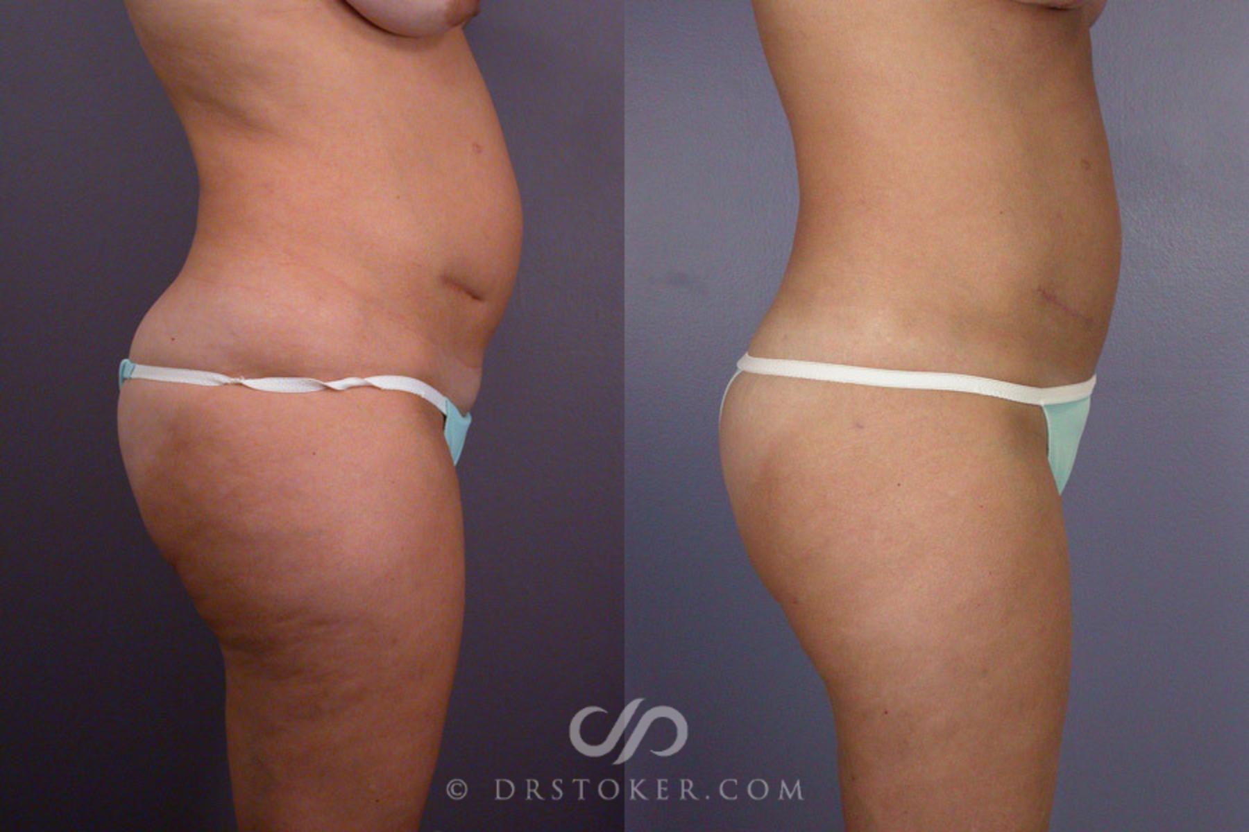 Before & After Liposuction Case 175 View #4 View in Los Angeles, CA
