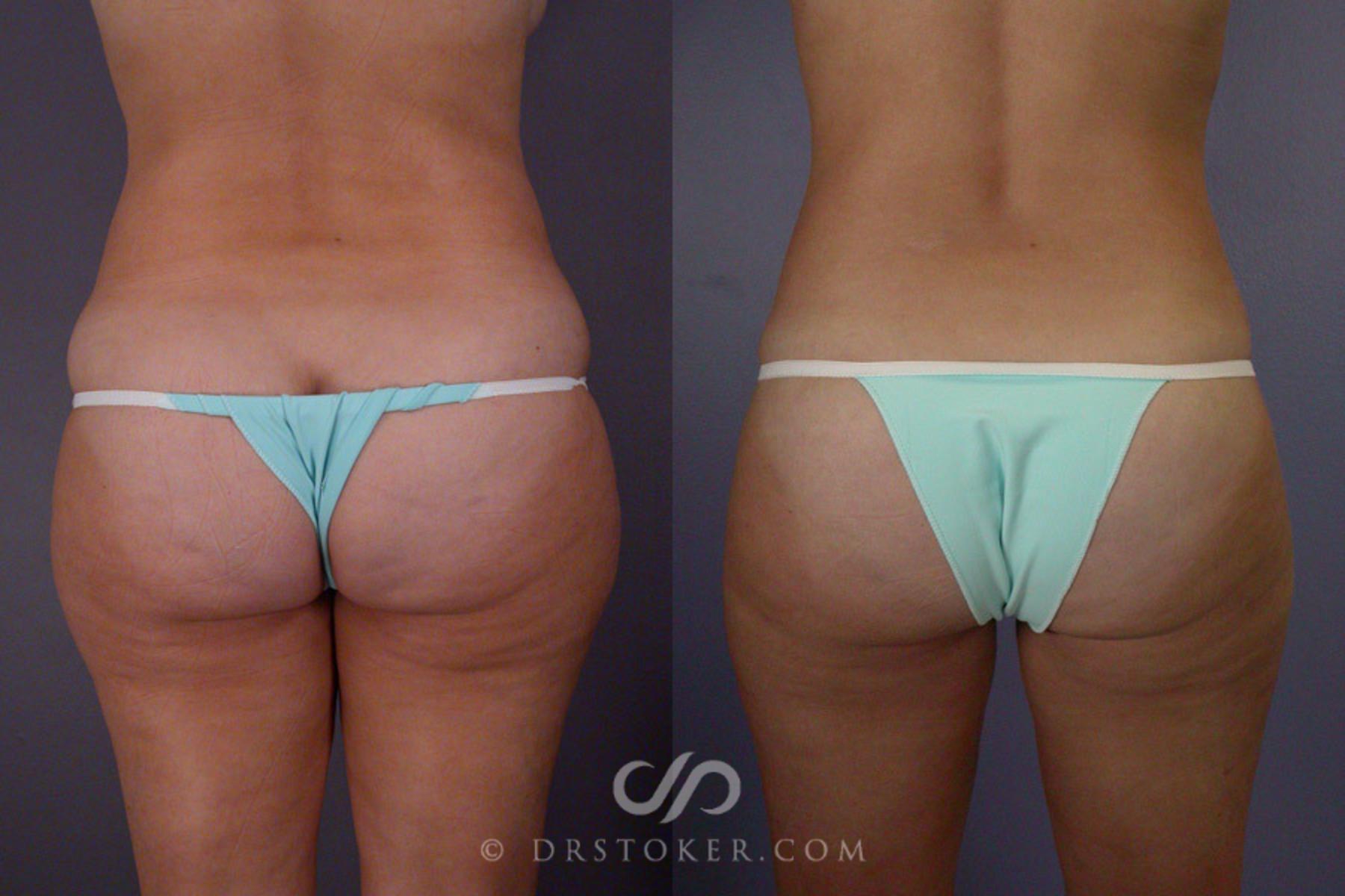 Before & After Liposuction Case 175 View #5 View in Los Angeles, CA