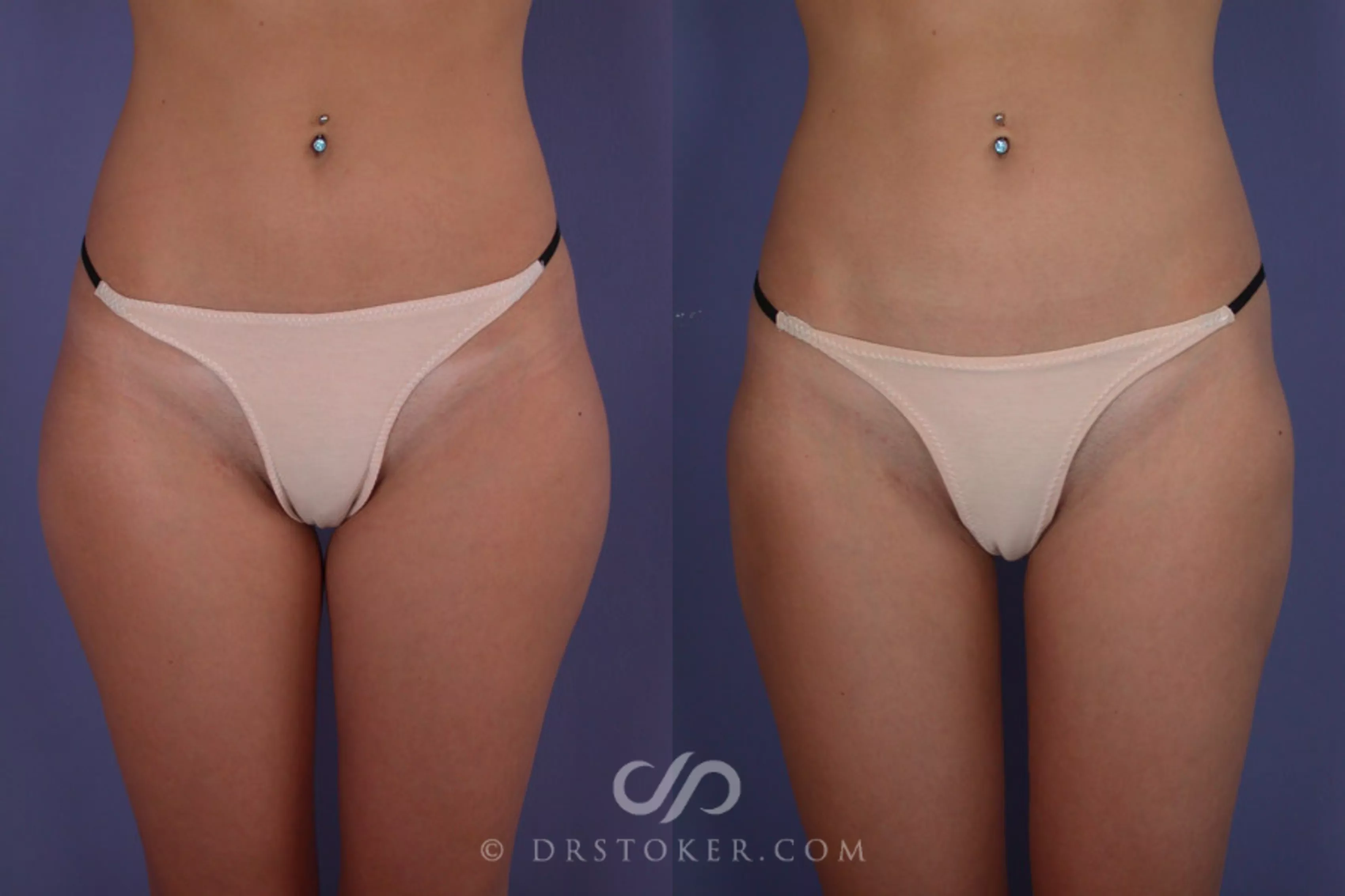 Liposuction Before and After Pictures Case 176, Los Angeles, CA