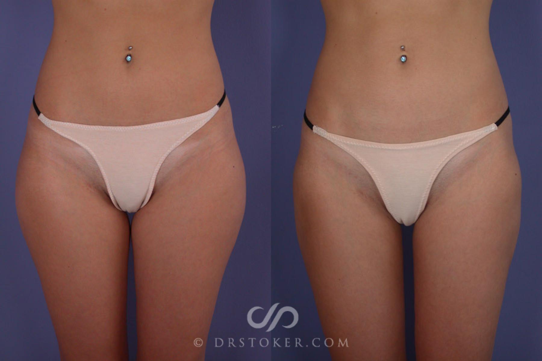 Plastic Surgery Case Study - Pubic Lift with Liposuction for Mons
