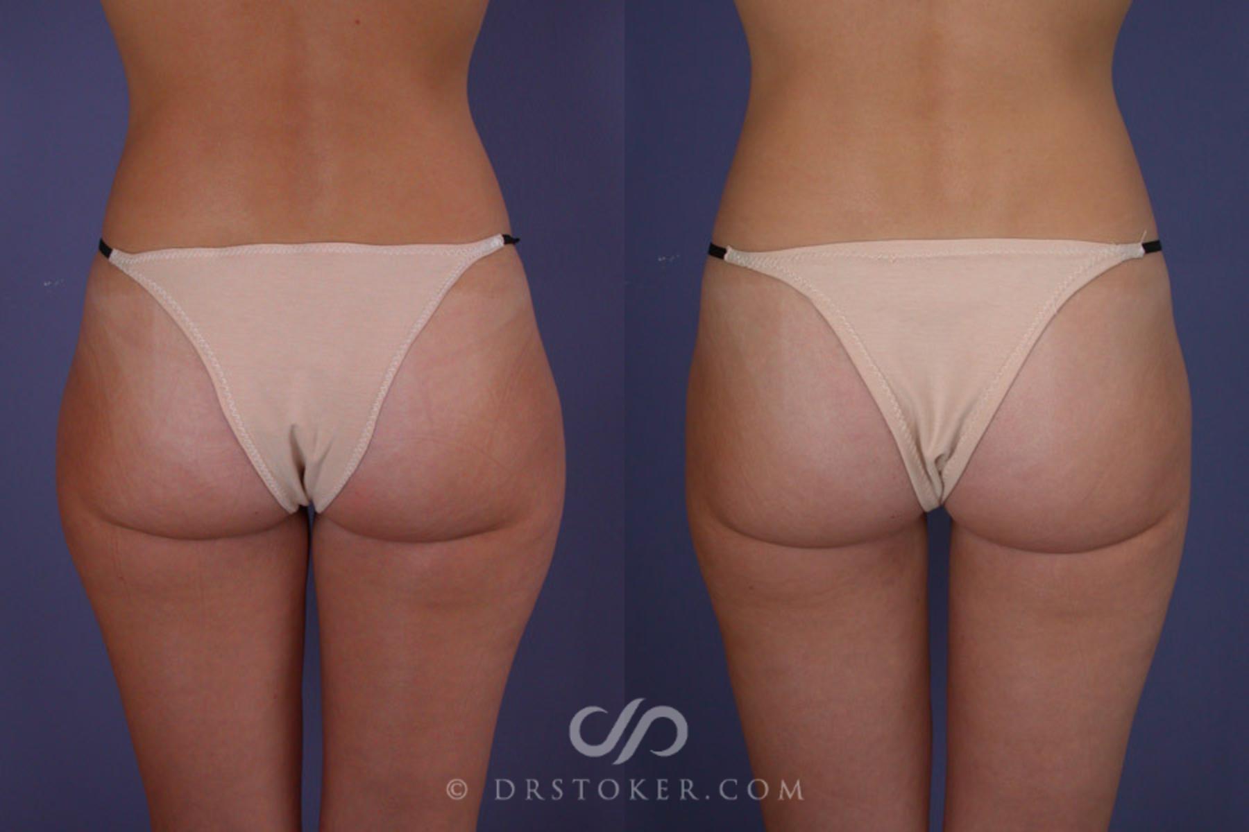 Before & After Liposuction Case 176 View #2 View in Los Angeles, CA