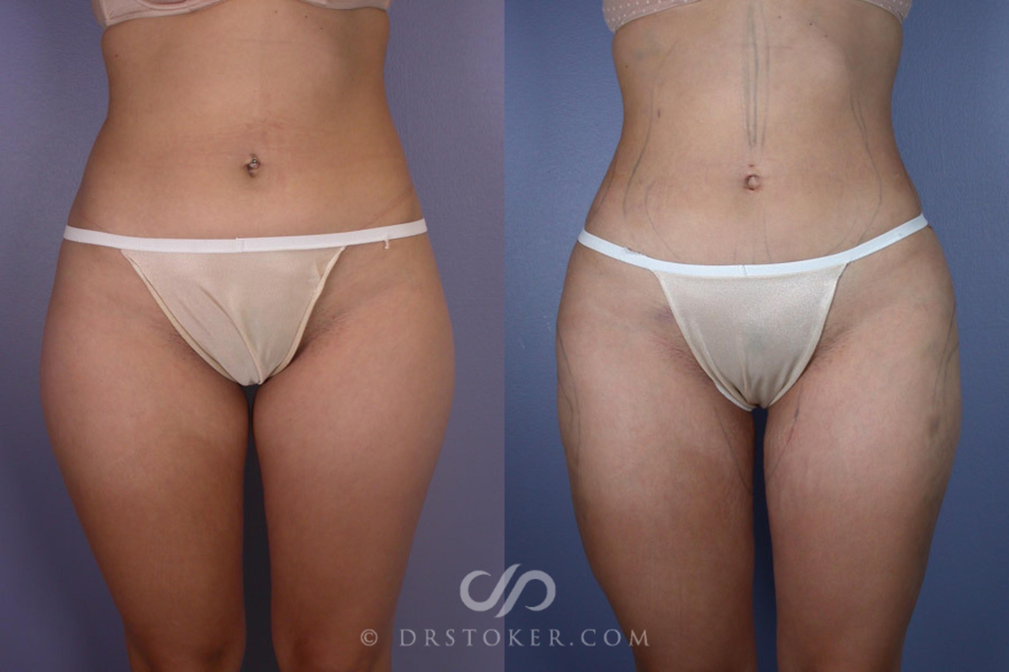 Before & After Liposuction Case 177 View #1 View in Los Angeles, CA