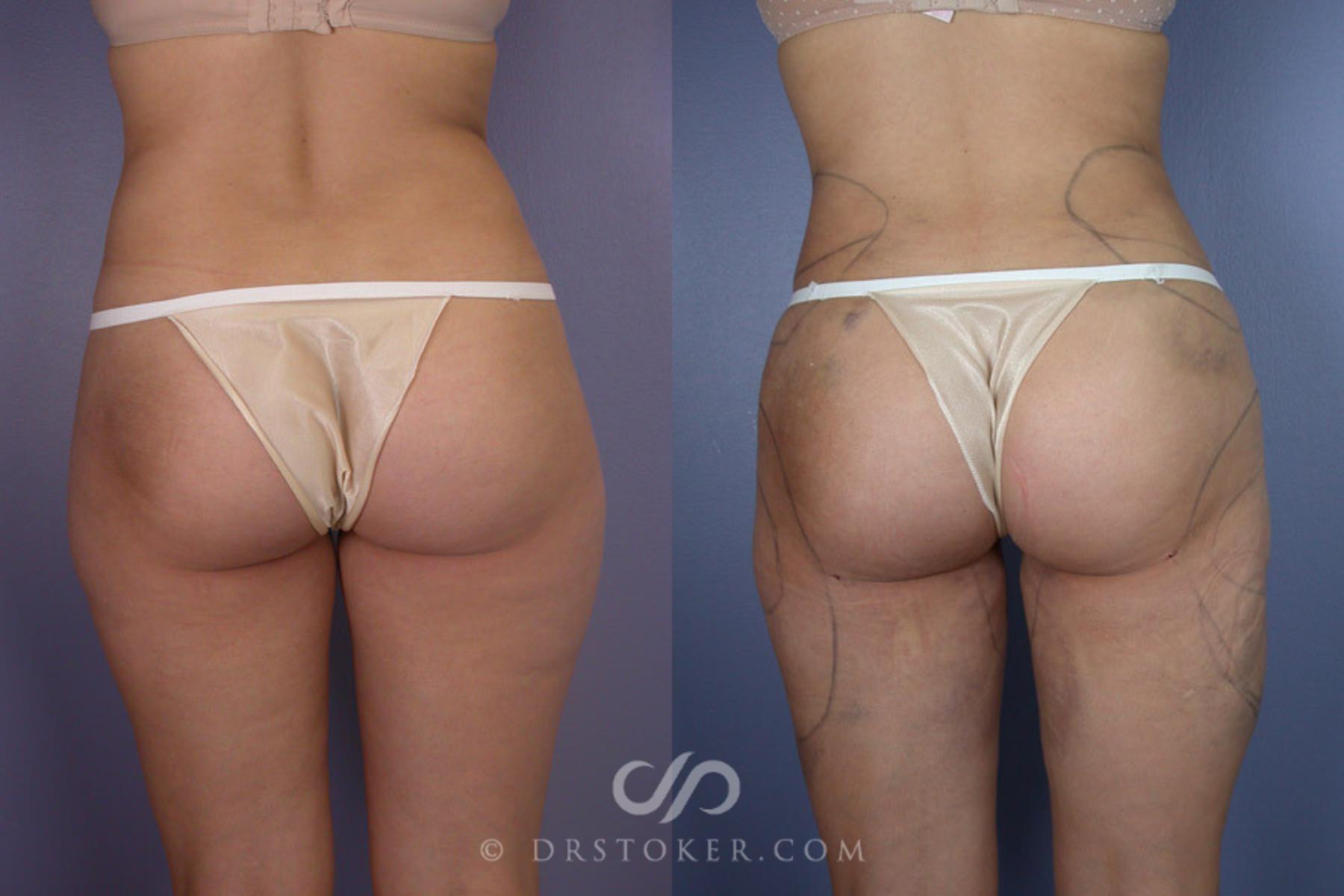 Before & After Liposuction Case 177 View #2 View in Los Angeles, CA