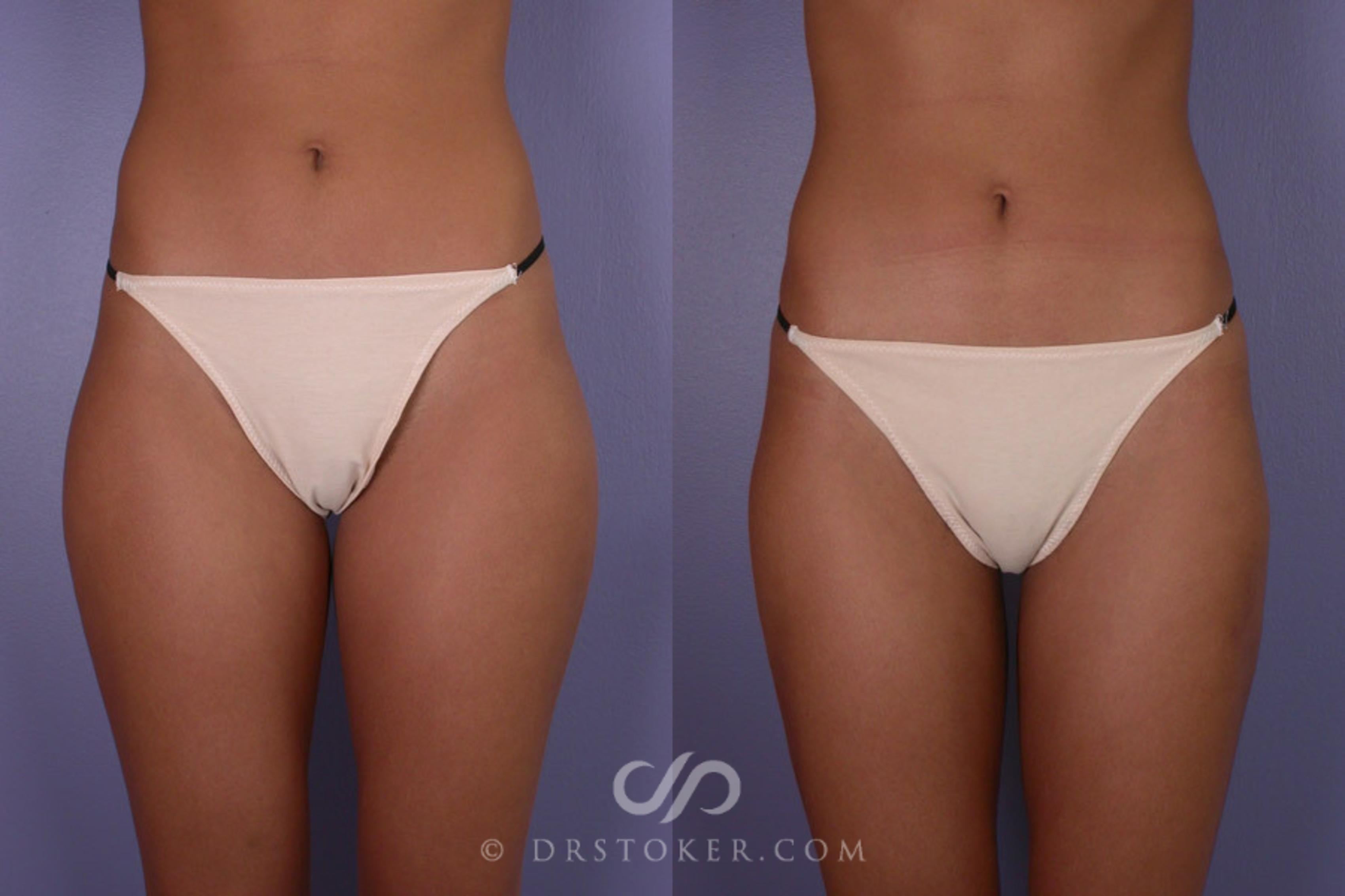 Before & After Liposuction Case 178 View #1 View in Los Angeles, CA