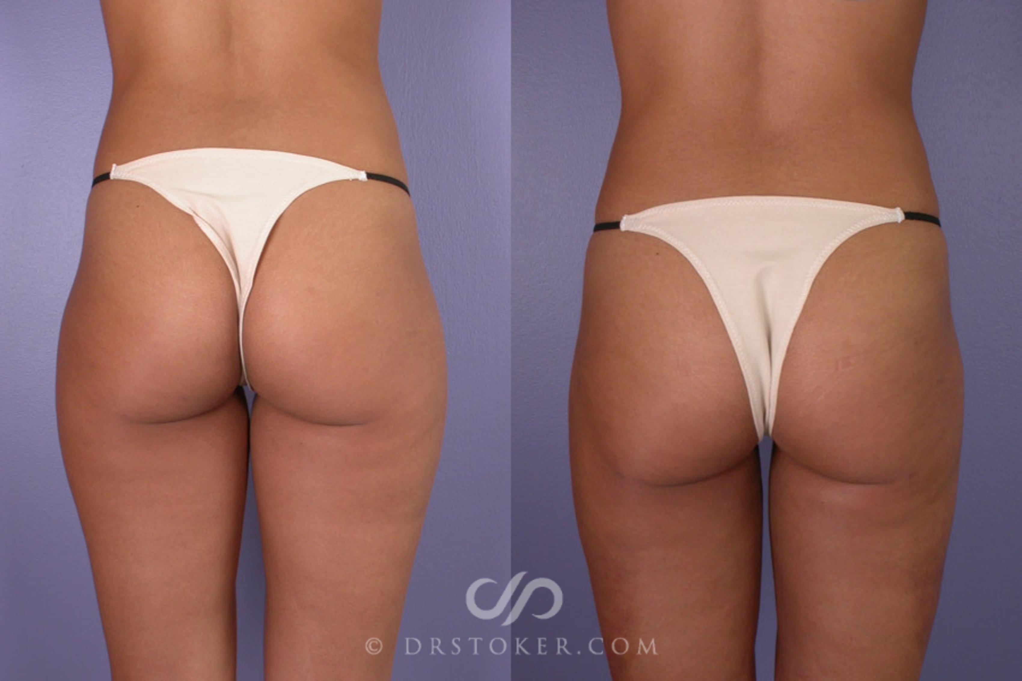 Before & After Liposuction Case 178 View #2 View in Los Angeles, CA