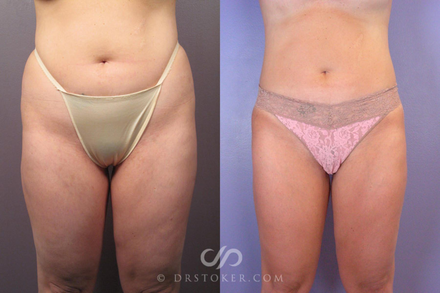 Before & After Liposuction Case 179 View #1 View in Los Angeles, CA