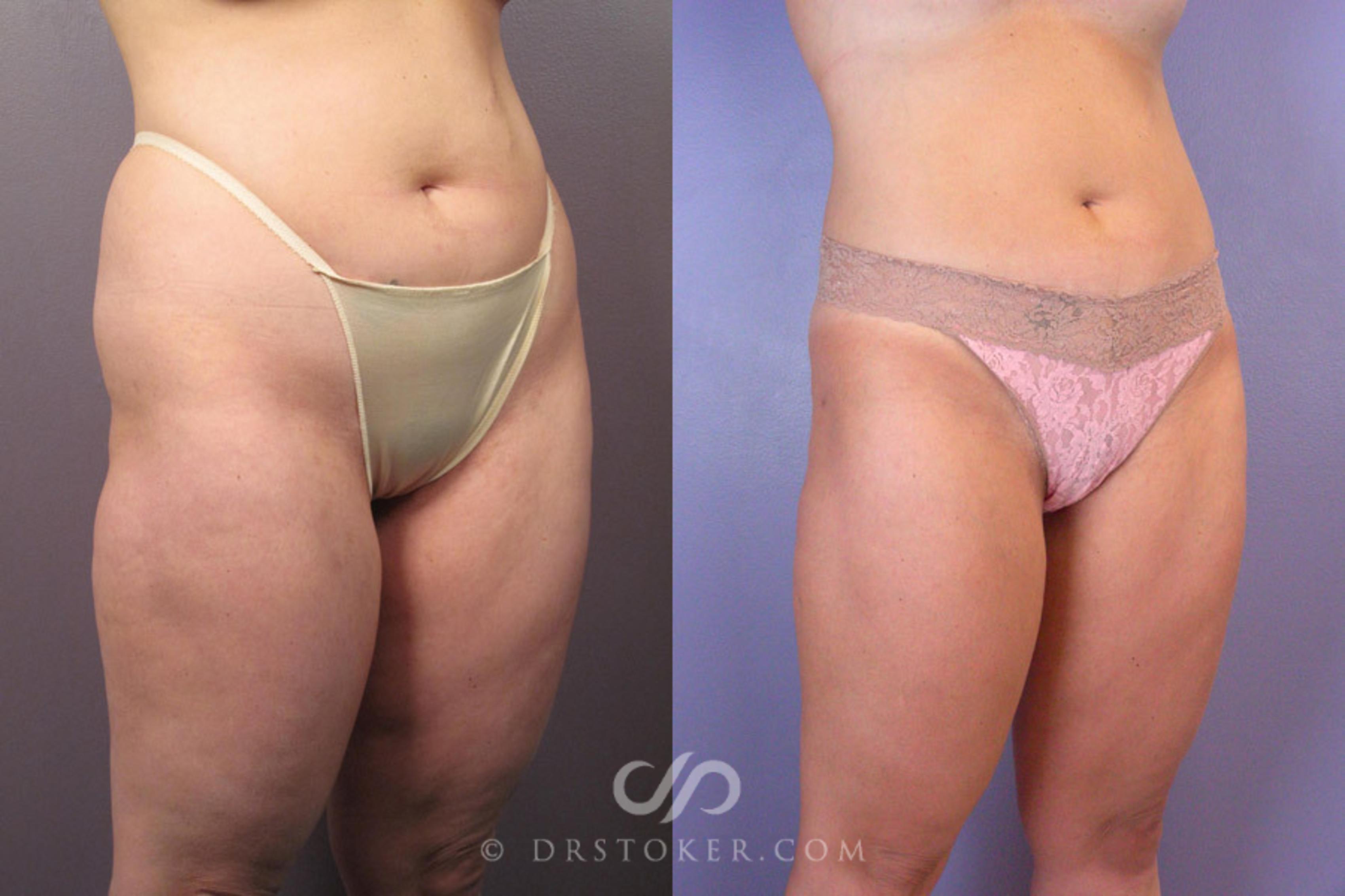 Before & After Liposuction Case 179 View #2 View in Los Angeles, CA