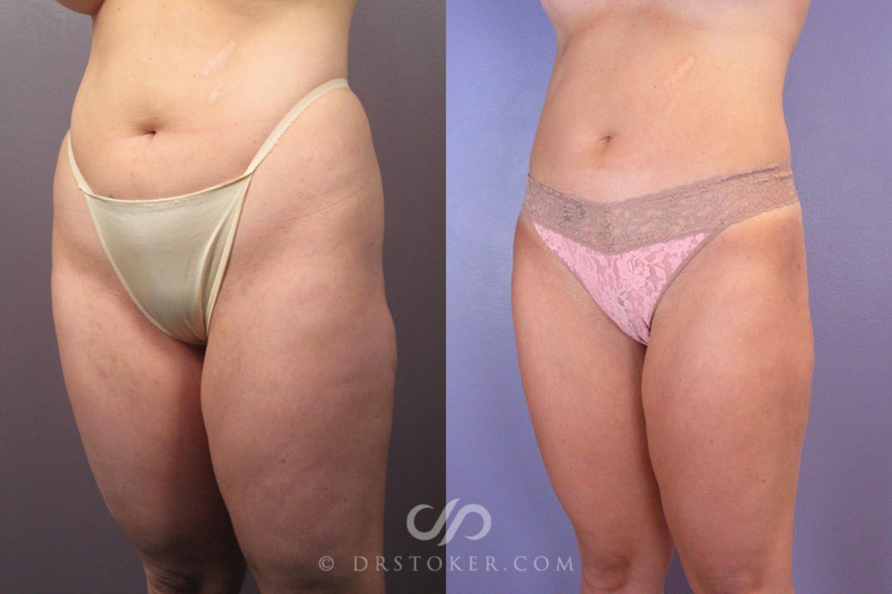 Before & After Liposuction Case 179 View #3 View in Los Angeles, CA