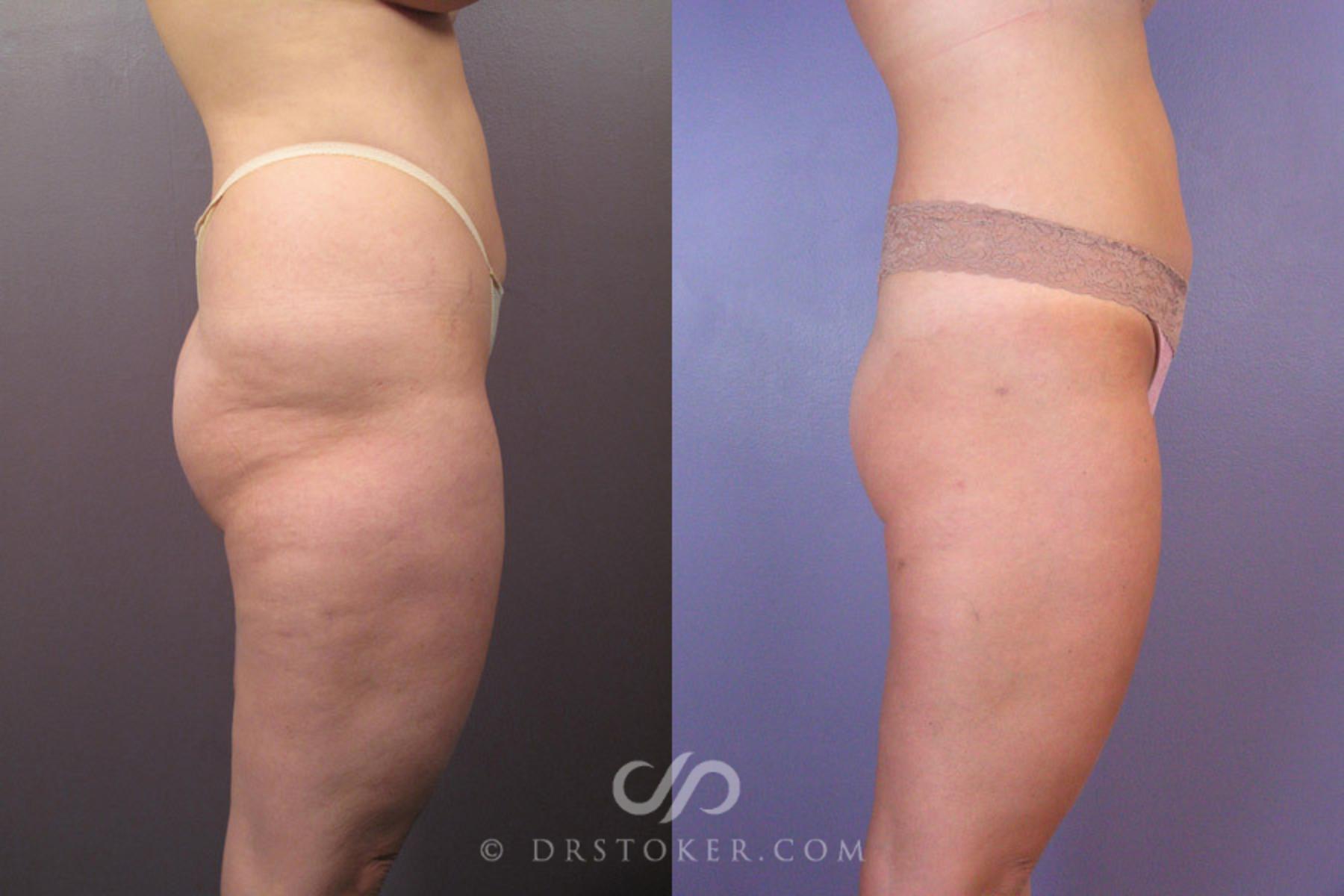Before & After Liposuction Case 179 View #4 View in Los Angeles, CA