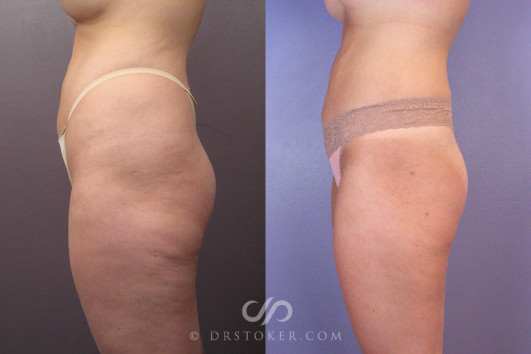 Before & After Liposuction Case 179 View #5 View in Los Angeles, CA