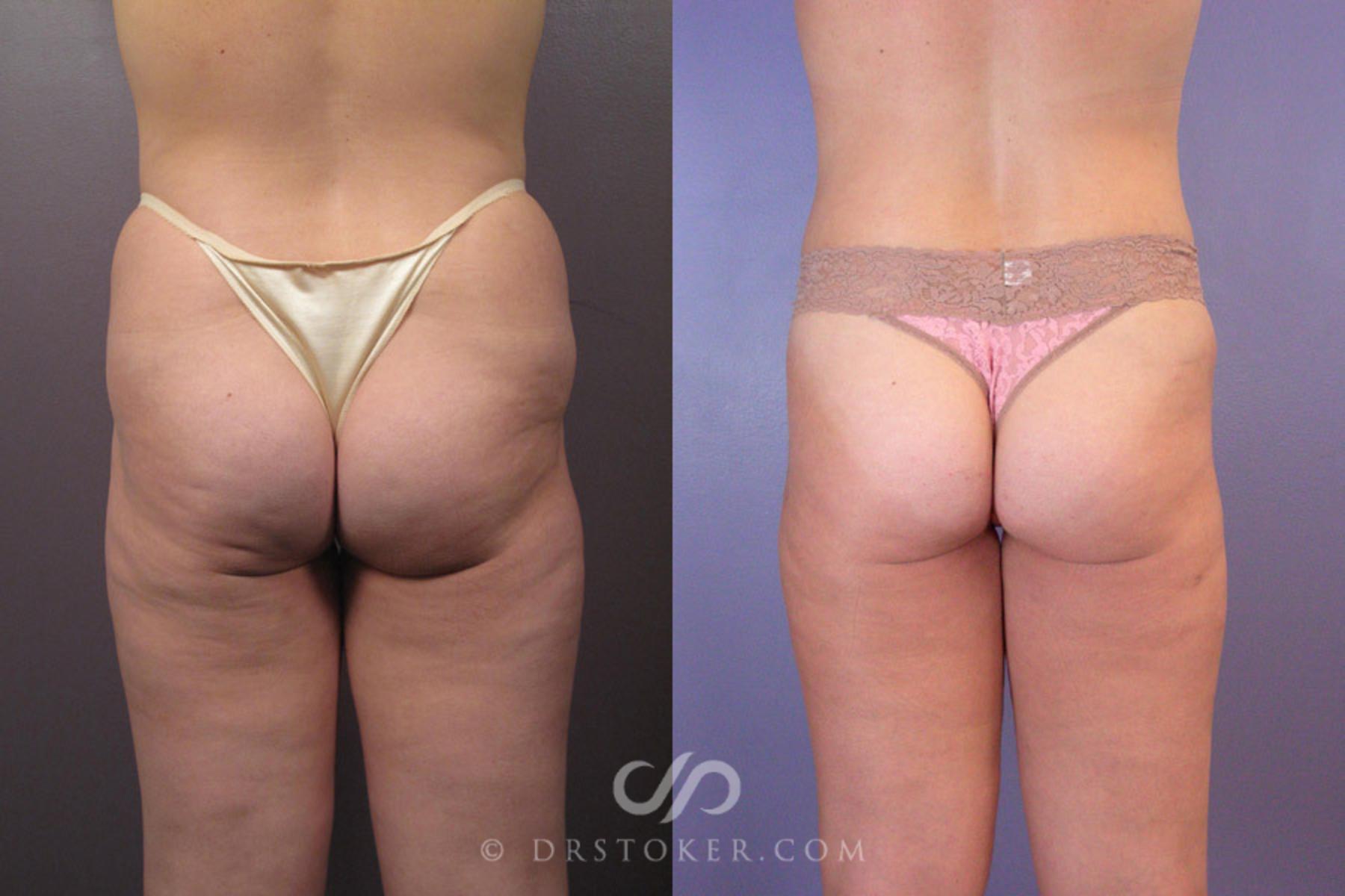 Before & After Liposuction Case 179 View #6 View in Los Angeles, CA
