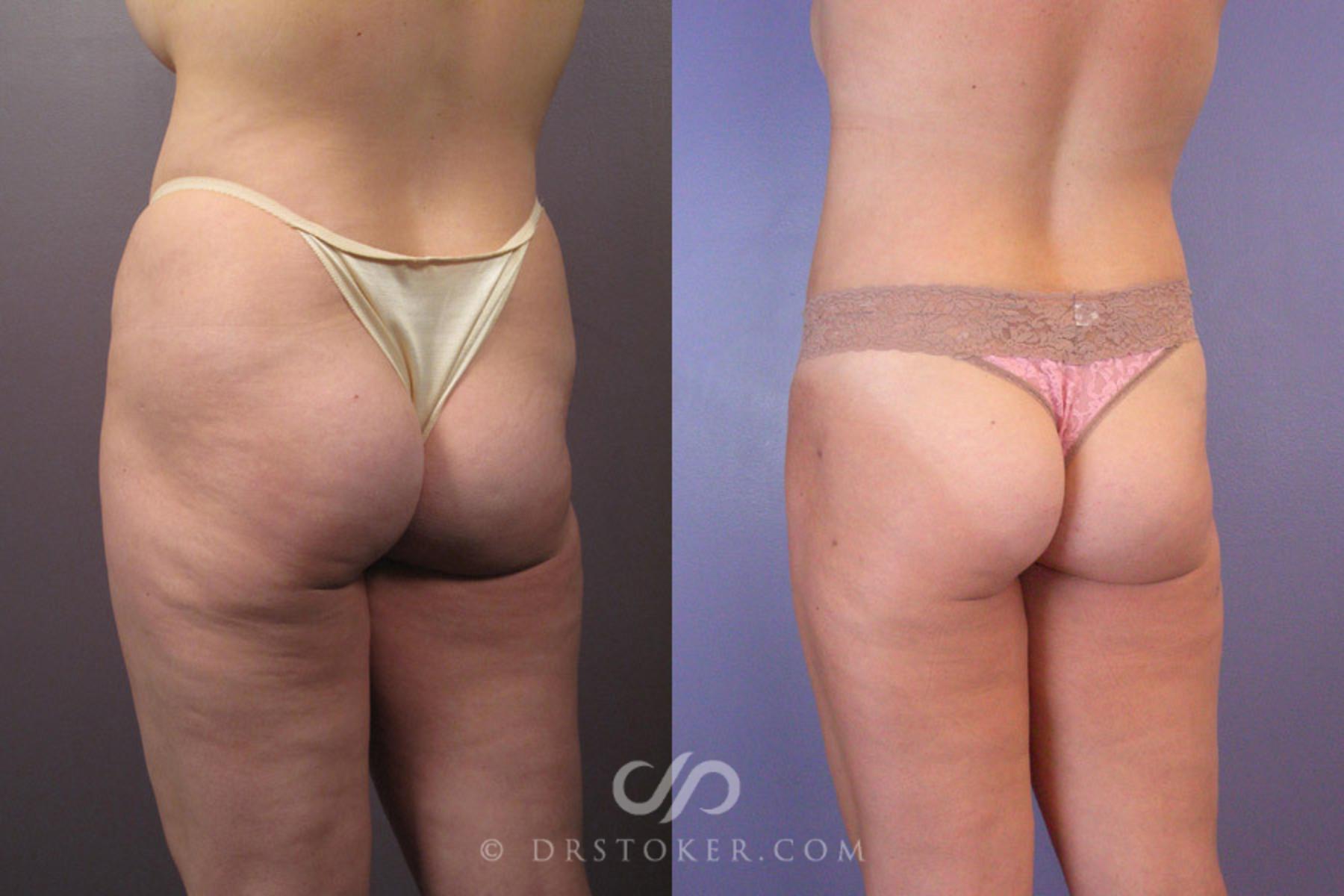 Before & After Liposuction Case 179 View #7 View in Los Angeles, CA