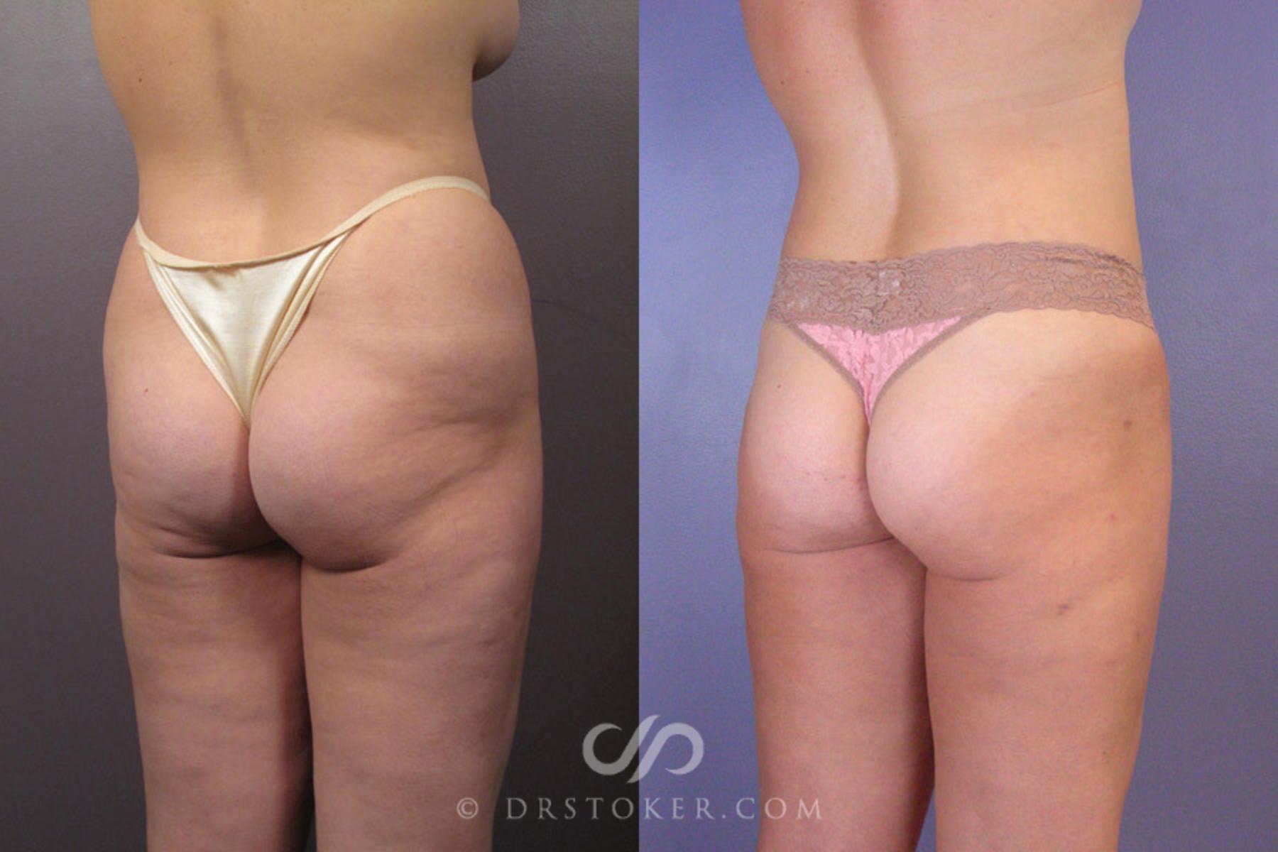 Before & After Liposuction Case 179 View #8 View in Los Angeles, CA