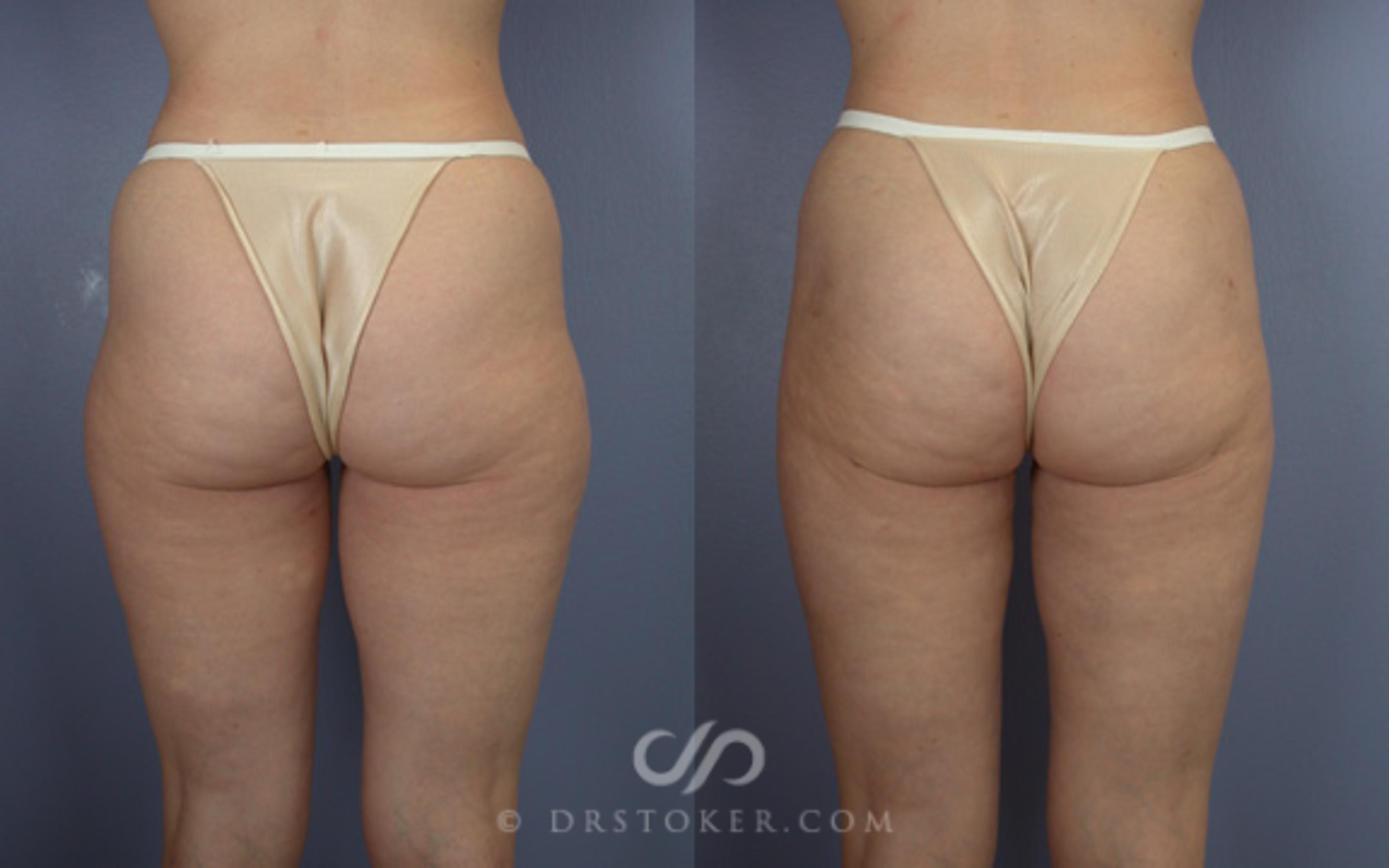 Before & After Liposuction Case 18 View #1 View in Los Angeles, CA