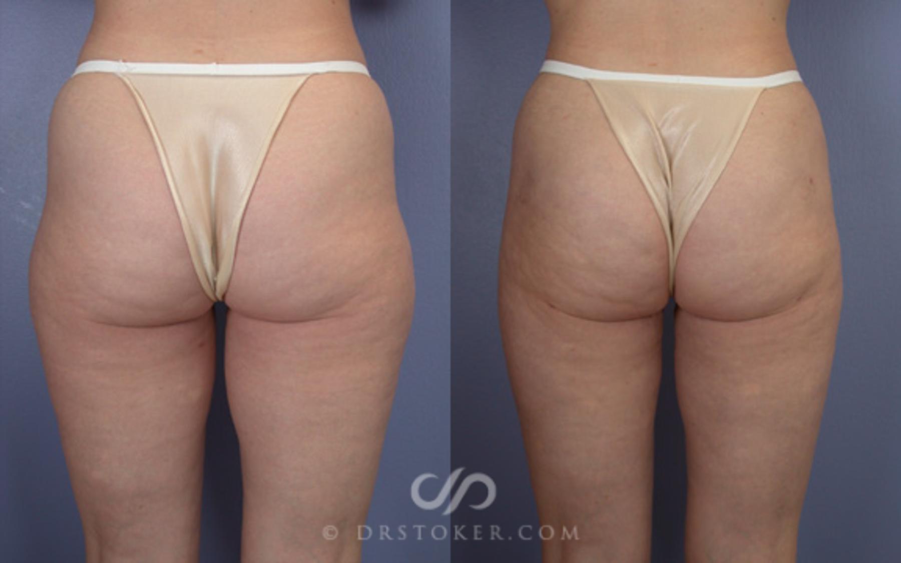 Before & After Liposuction Case 18 View #2 View in Los Angeles, CA