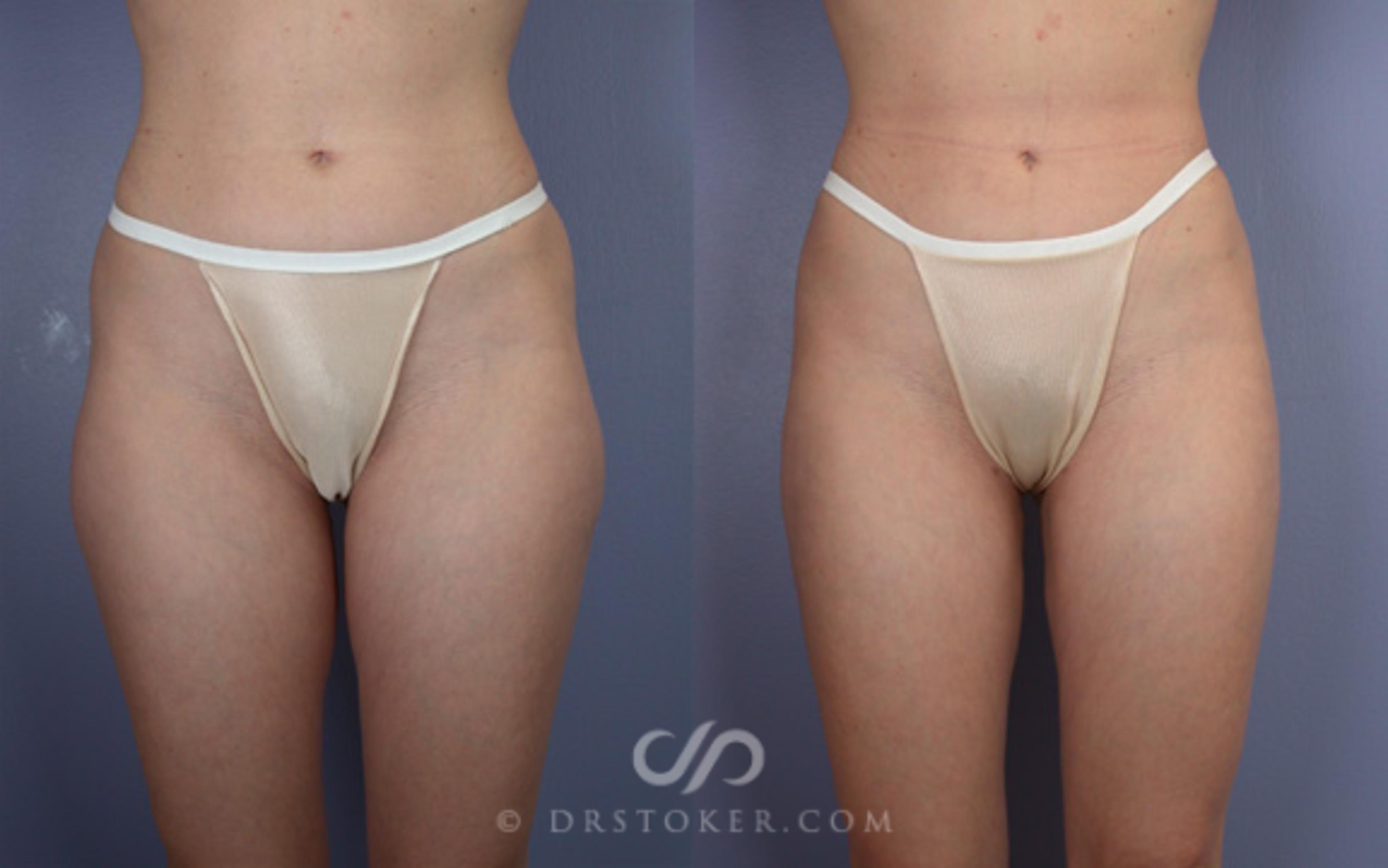 Before & After Liposuction Case 18 View #3 View in Los Angeles, CA