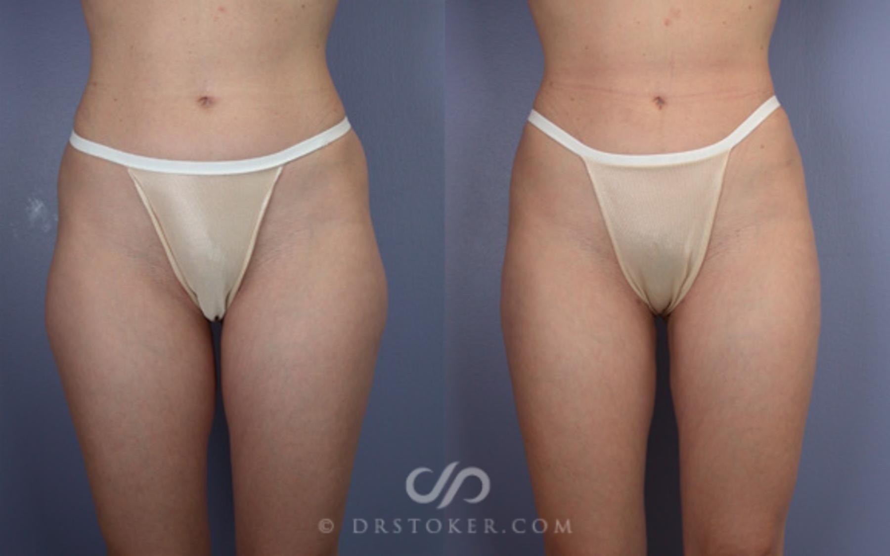Before & After Liposuction Case 18 View #3 View in Los Angeles, CA