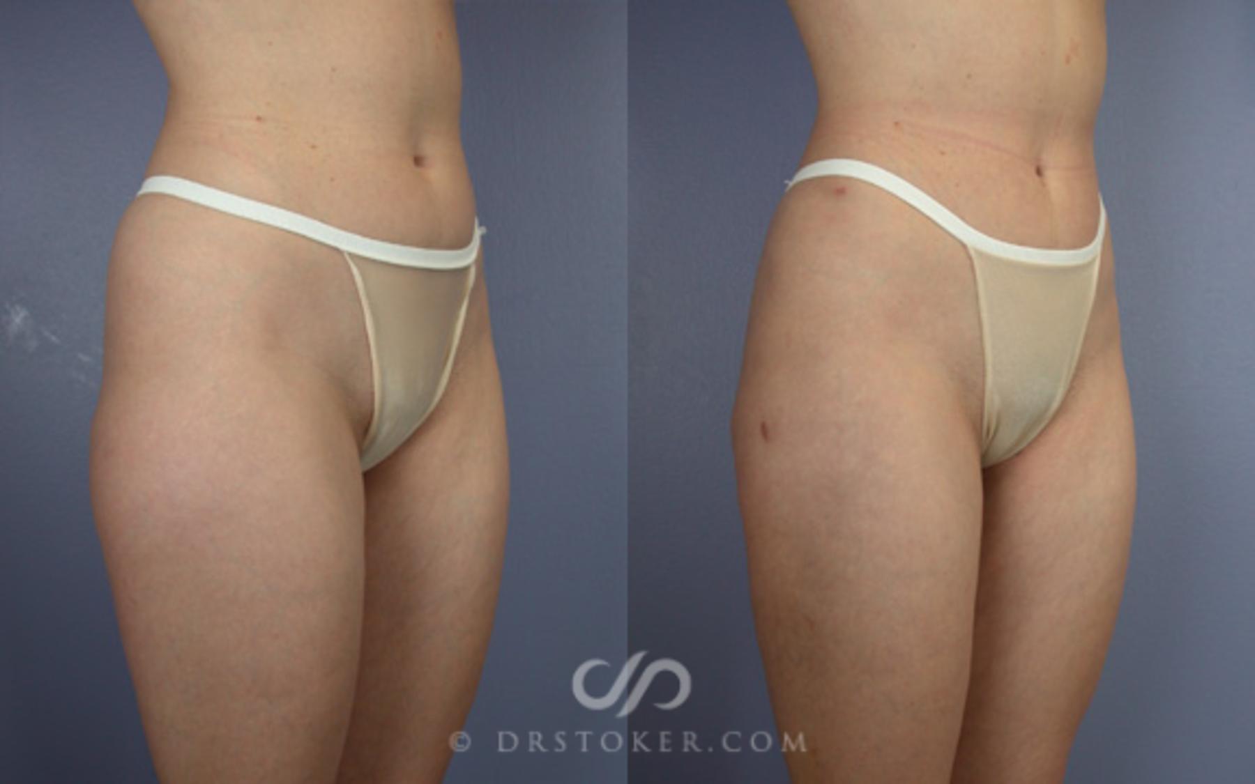 Before & After Liposuction Case 18 View #4 View in Los Angeles, CA