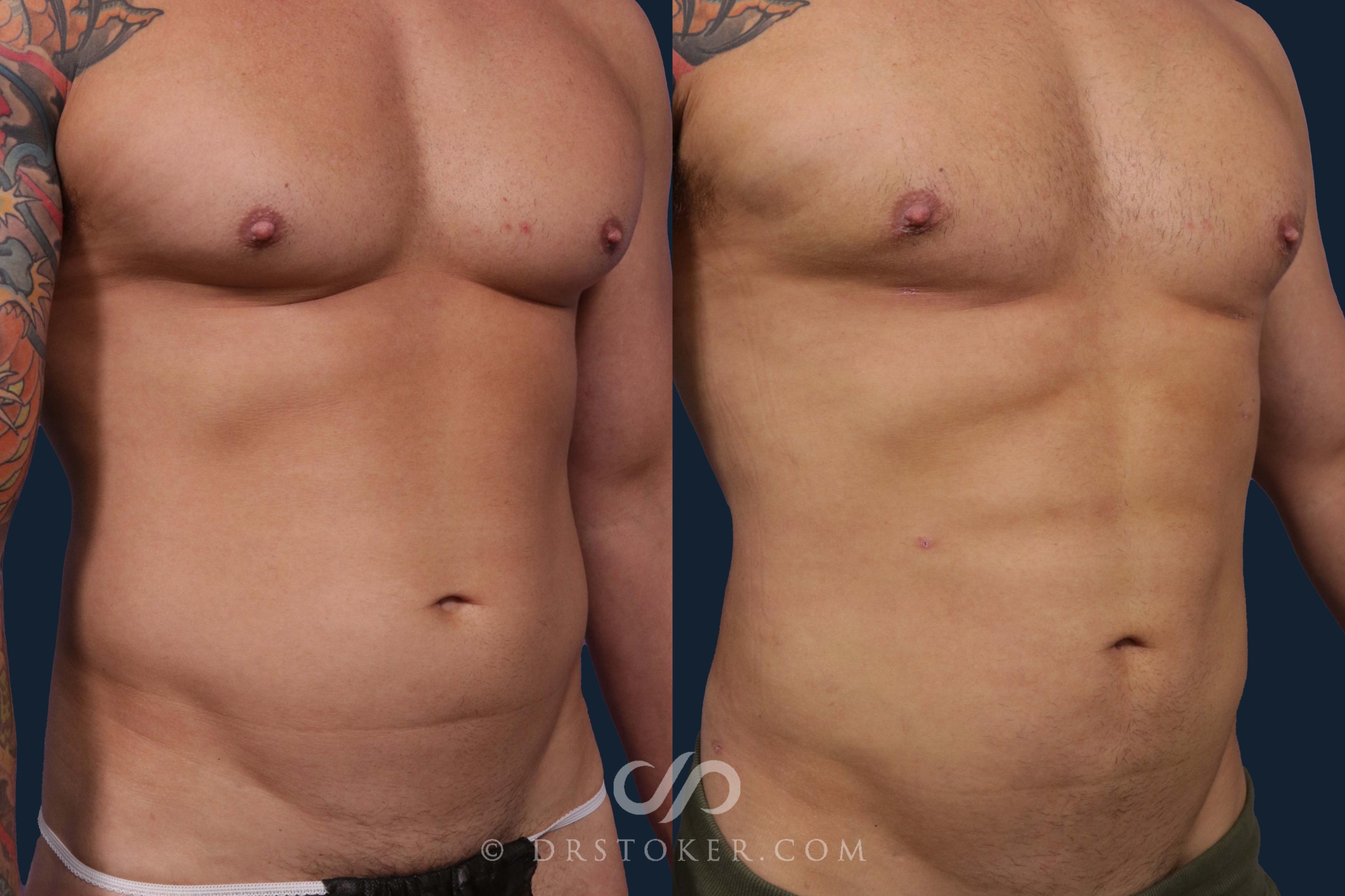 Before & After Liposuction Case 1889 Front View in Los Angeles, CA