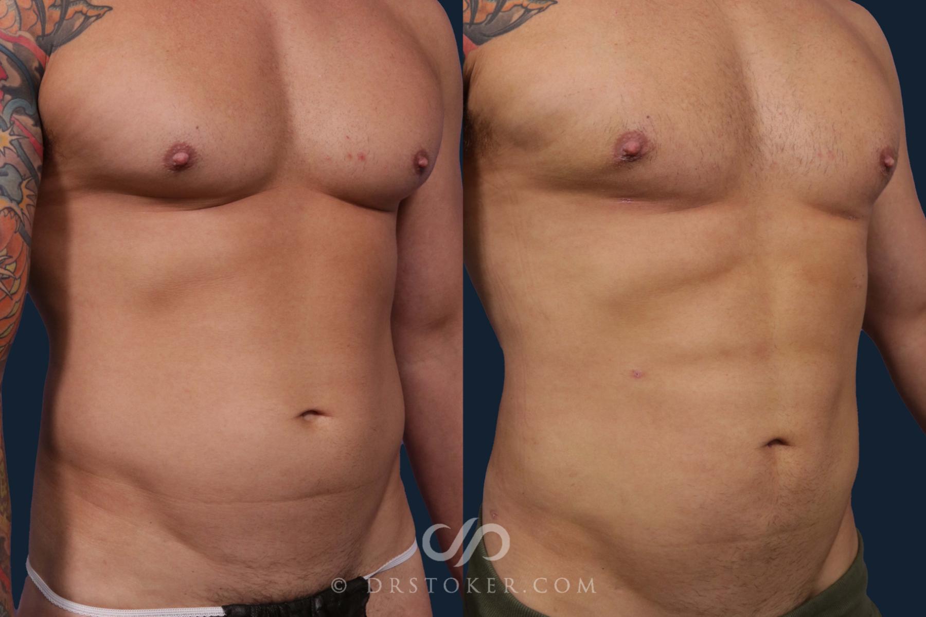 Before & After Liposuction Case 1889 Front View in Los Angeles, CA