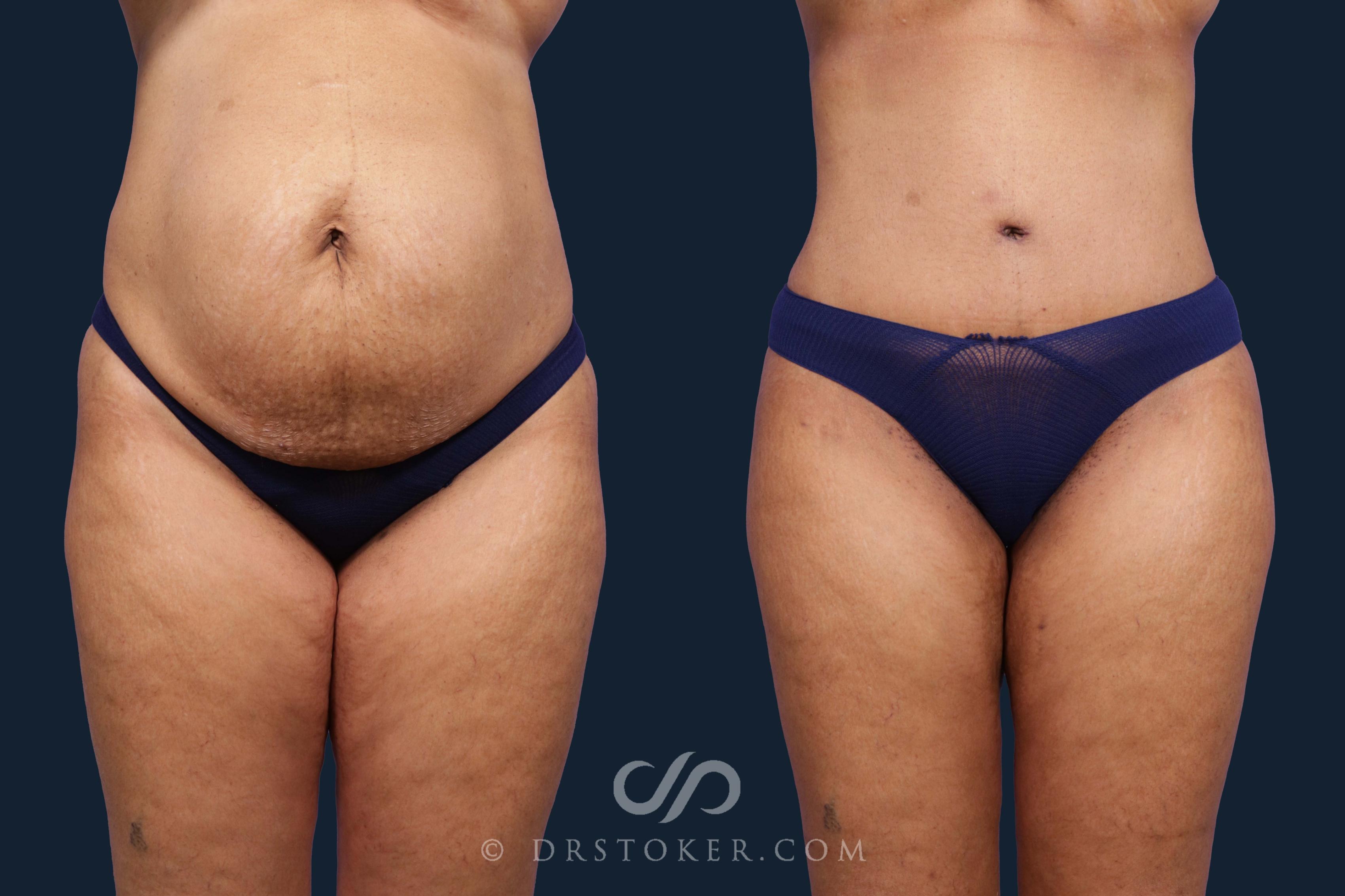 Before & After Liposuction Case 1891 Front View in Los Angeles, CA