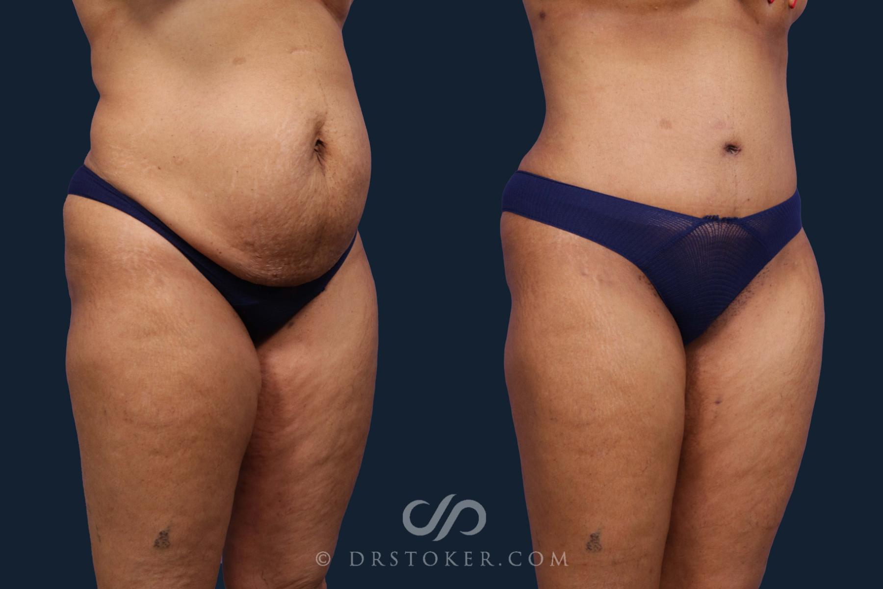 Before & After Liposuction Case 1892 Right Oblique View in Los Angeles, CA