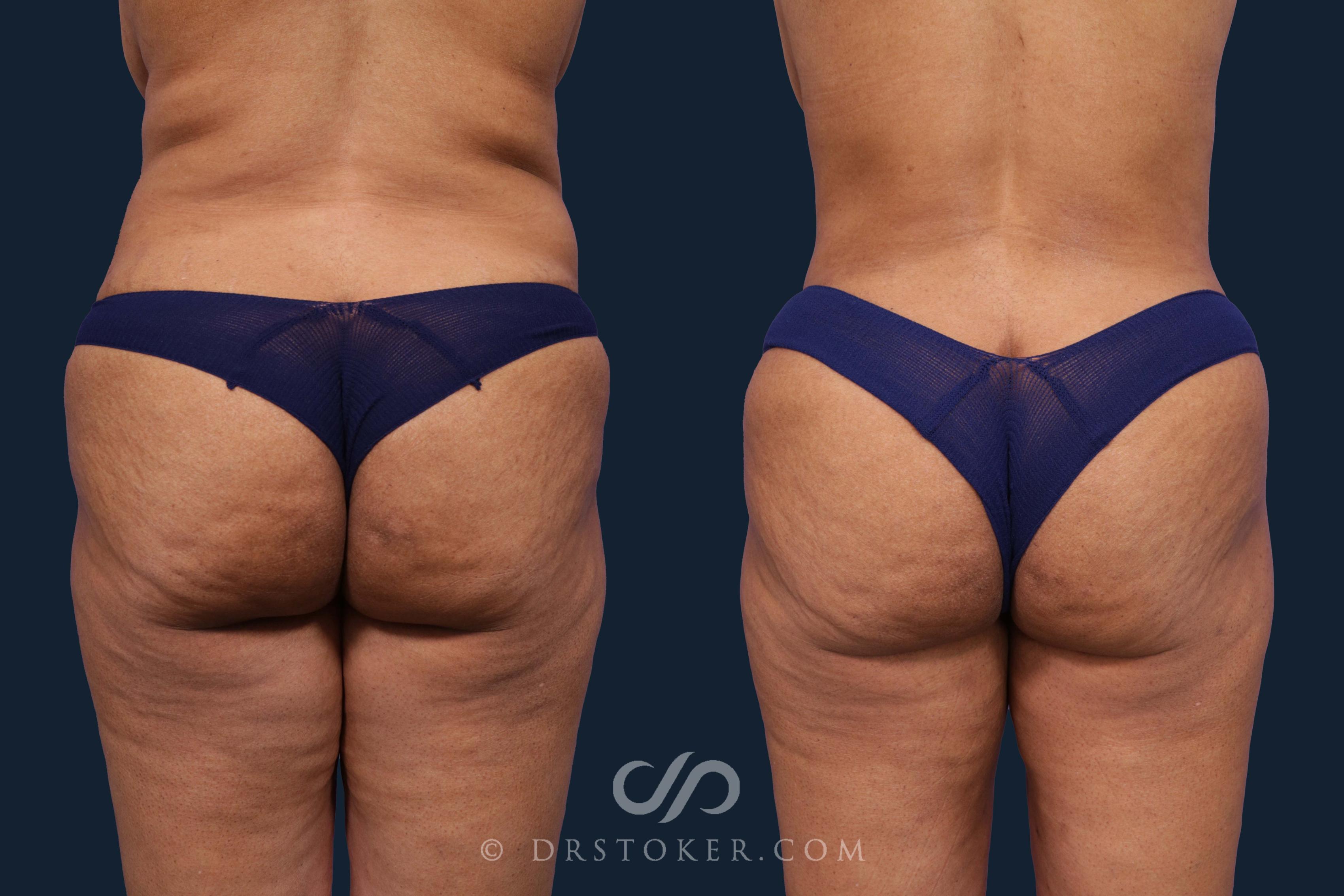 Before & After Liposuction Case 1893 Back View in Los Angeles, CA