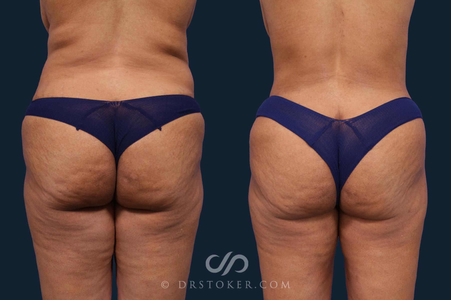 Before & After Liposuction Case 1893 Back View in Los Angeles, CA