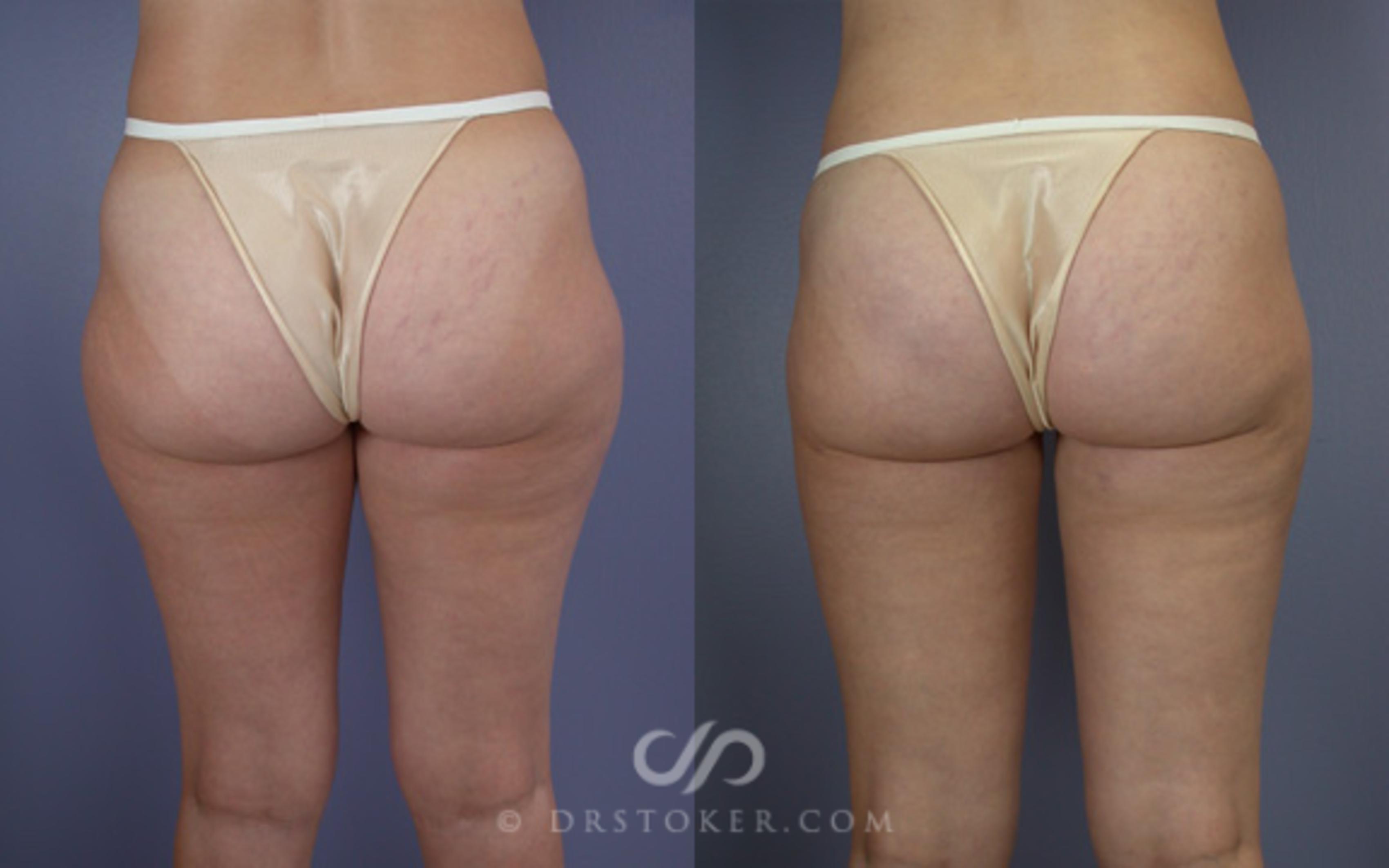 Before & After Liposuction Case 19 View #1 View in Los Angeles, CA