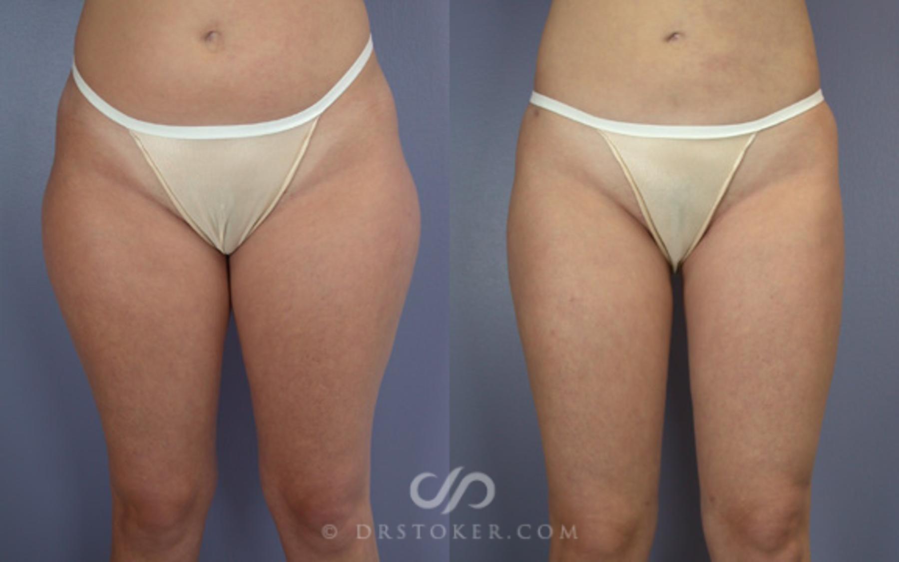 Before & After Liposuction Case 19 View #2 View in Los Angeles, CA